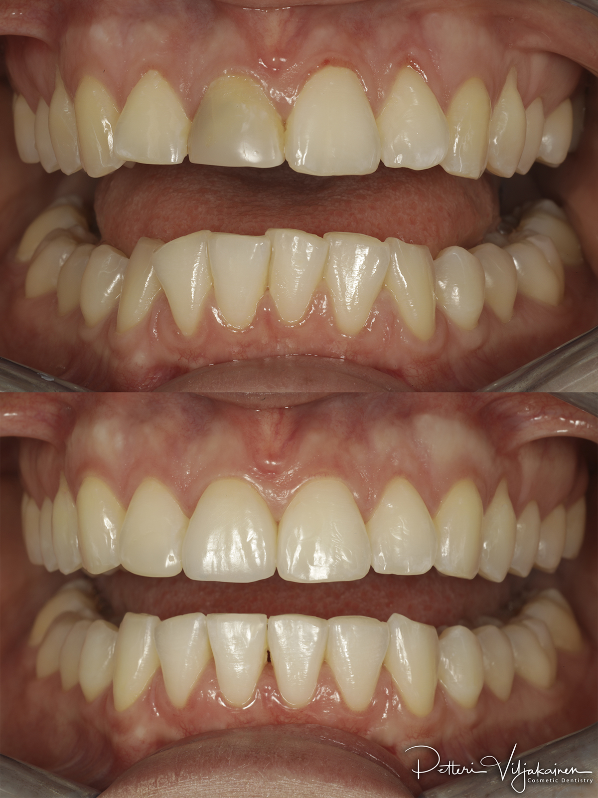 Esteettinen hammashoito ennen jälkeen. Keraamiset kuoret eli hammaslaminaatit neljässä yläetuhampaassa. Kulmahampaat korvattu implanttikruunuilla.