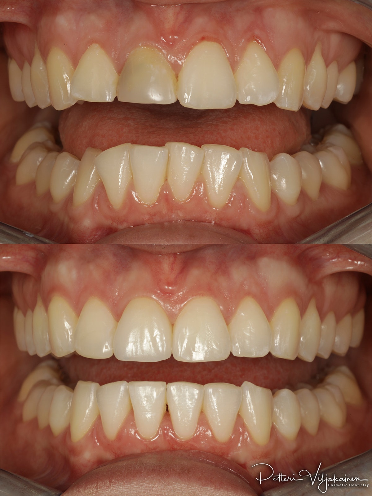 Esteettinen hammashoito ennen jälkeen. Keraamiset kuoret eli hammaslaminaatit neljässä yläetuhampaassa. Kulmahampaat korvattu implanttikruunuilla.