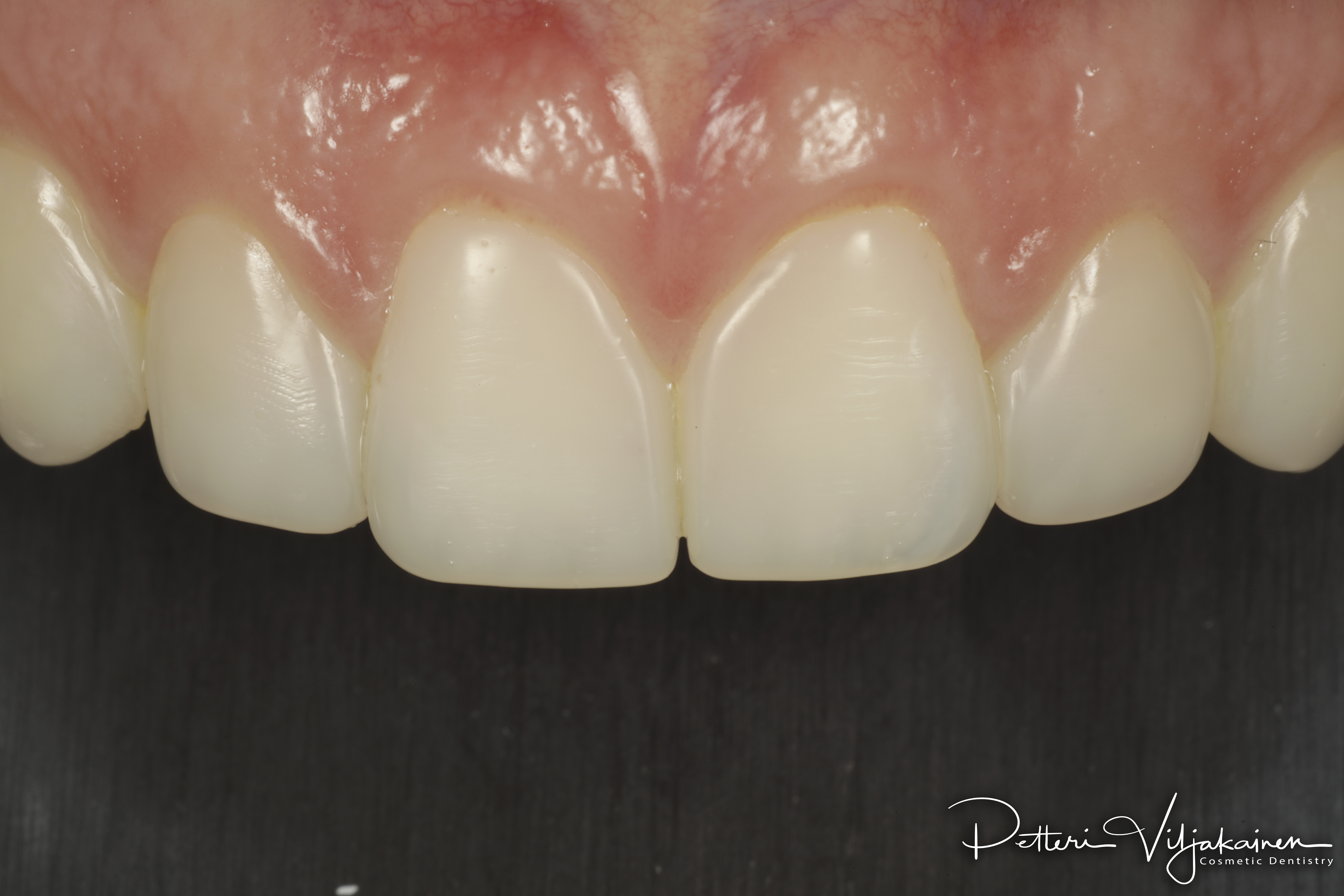 Muovilaminaatit. Edulliset laminaatit hampaisiin yhdistelmämuovista kerrostustekniikalla.