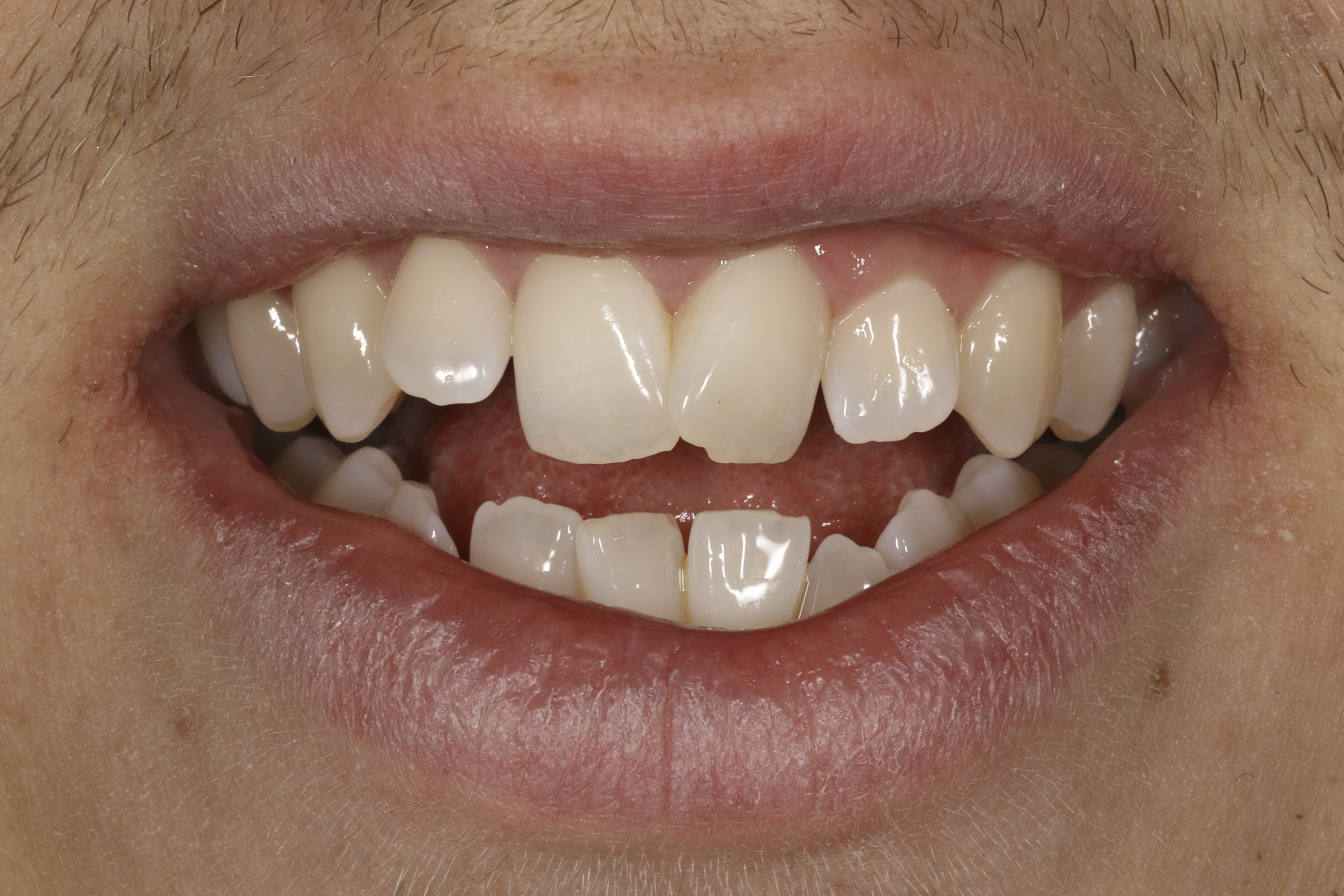 Invisalign oikomishoito tilanne ennen oikomista