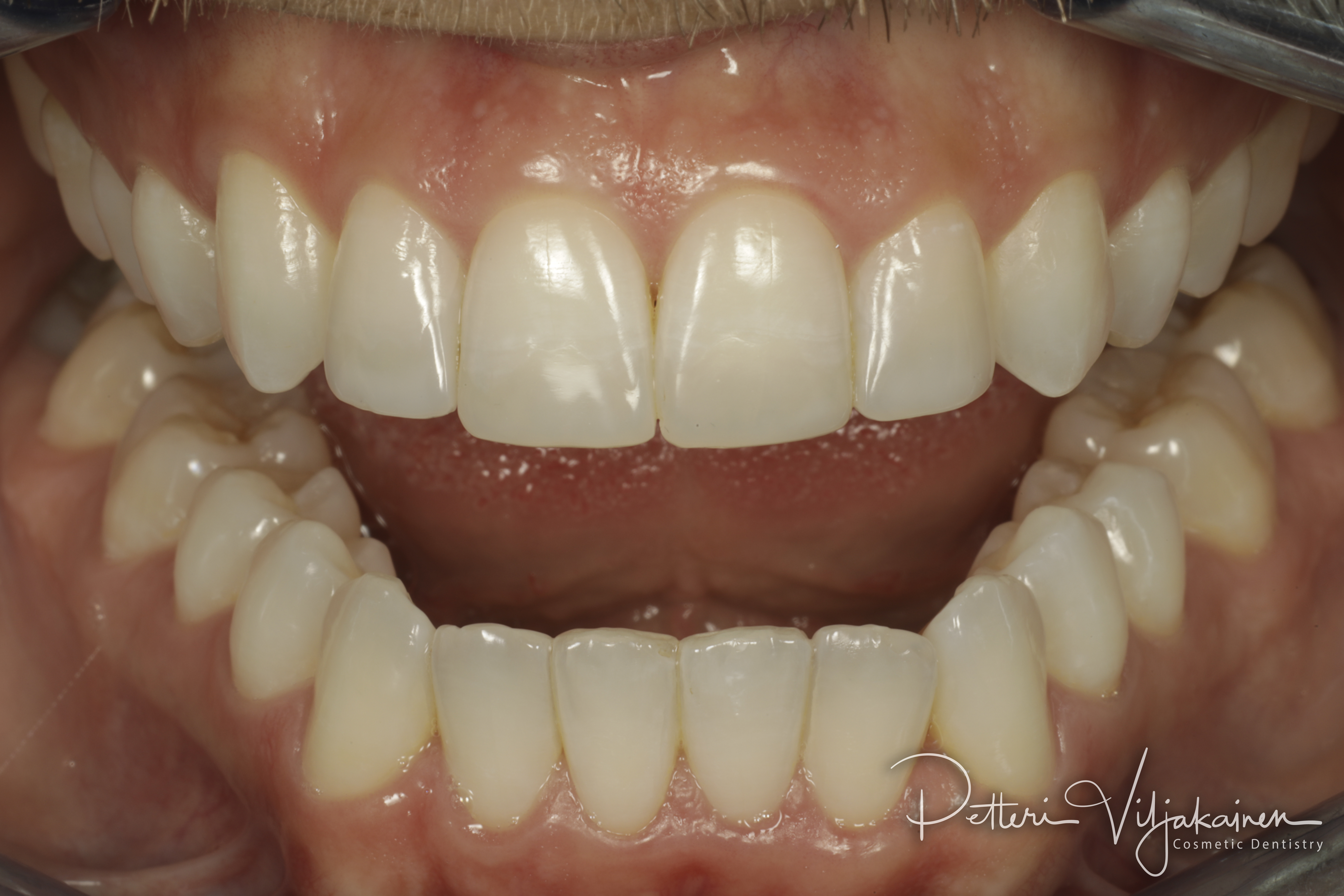 Invisalign oikomishoito / esteettiset kerrostusmuovit  lopputilanne.
