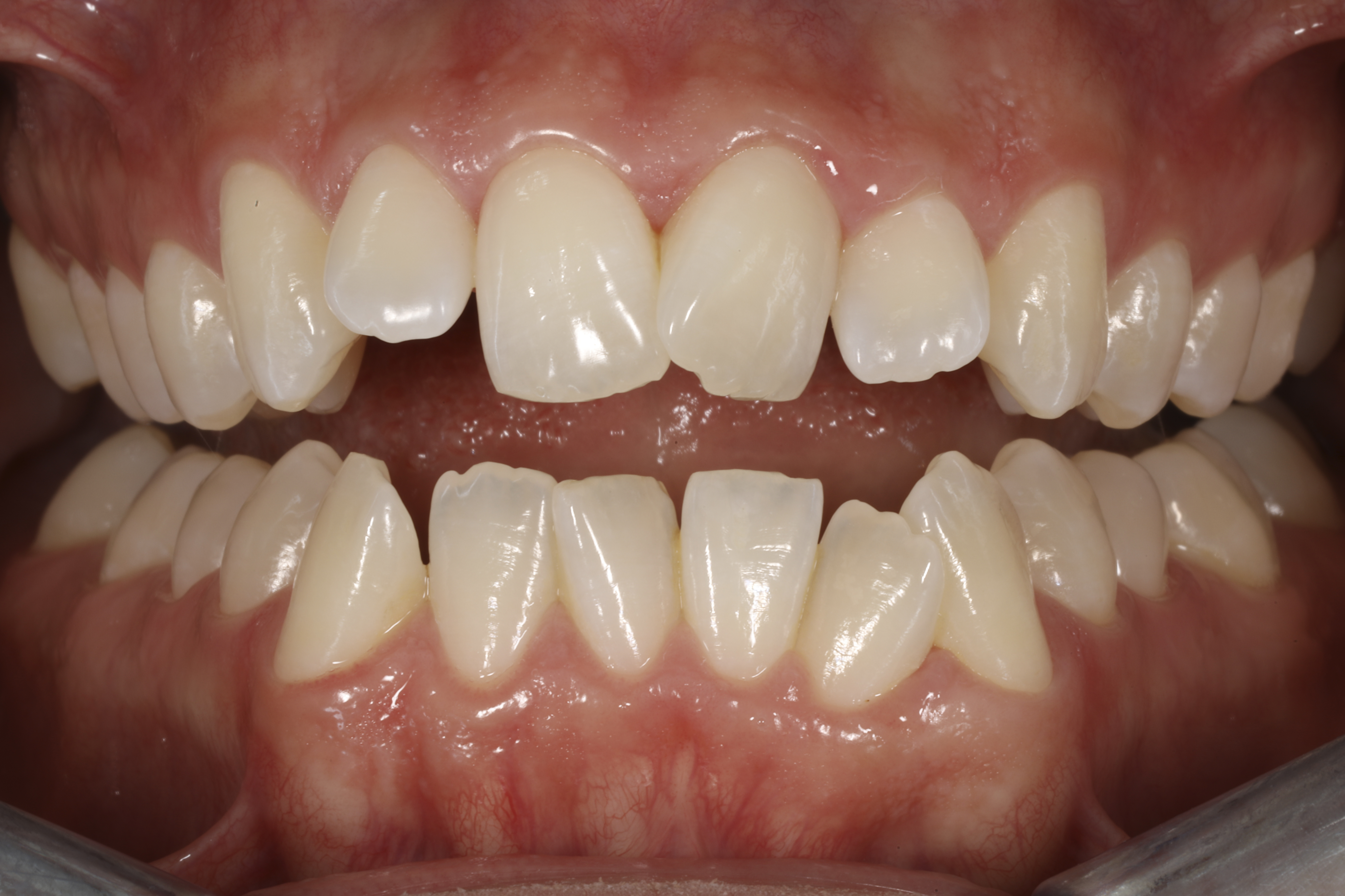 Invisalign oikomishoito tilanne ennen oikomista