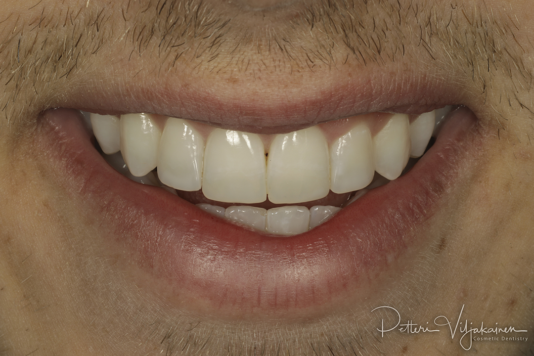 Invisalign oikomishoito / esteettiset kerrostusmuovit  lopputilanne.