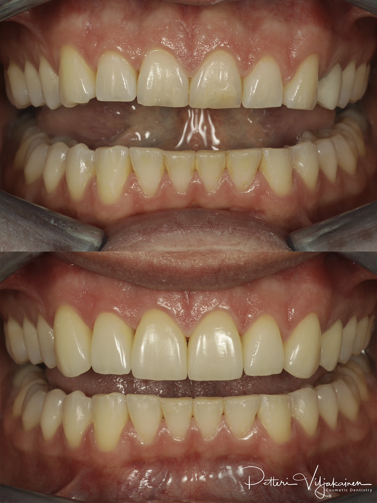 Esteettinen hammashoito ennen jälkeen. Keraamiset kuoret eli hammaslaminaatit reunimmaisissa yläetuhampaissa.