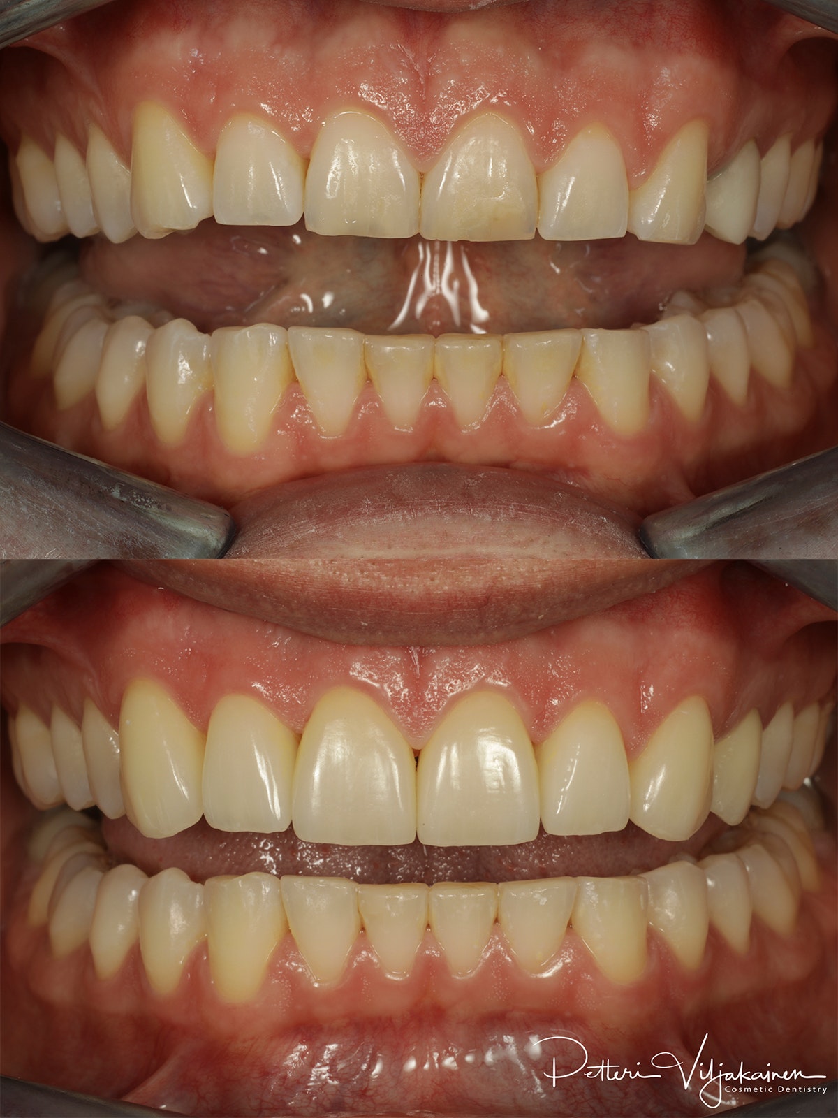 Esteettinen hammashoito ennen jälkeen. Keraamiset kuoret eli hammaslaminaatit reunimmaisissa yläetuhampaissa.