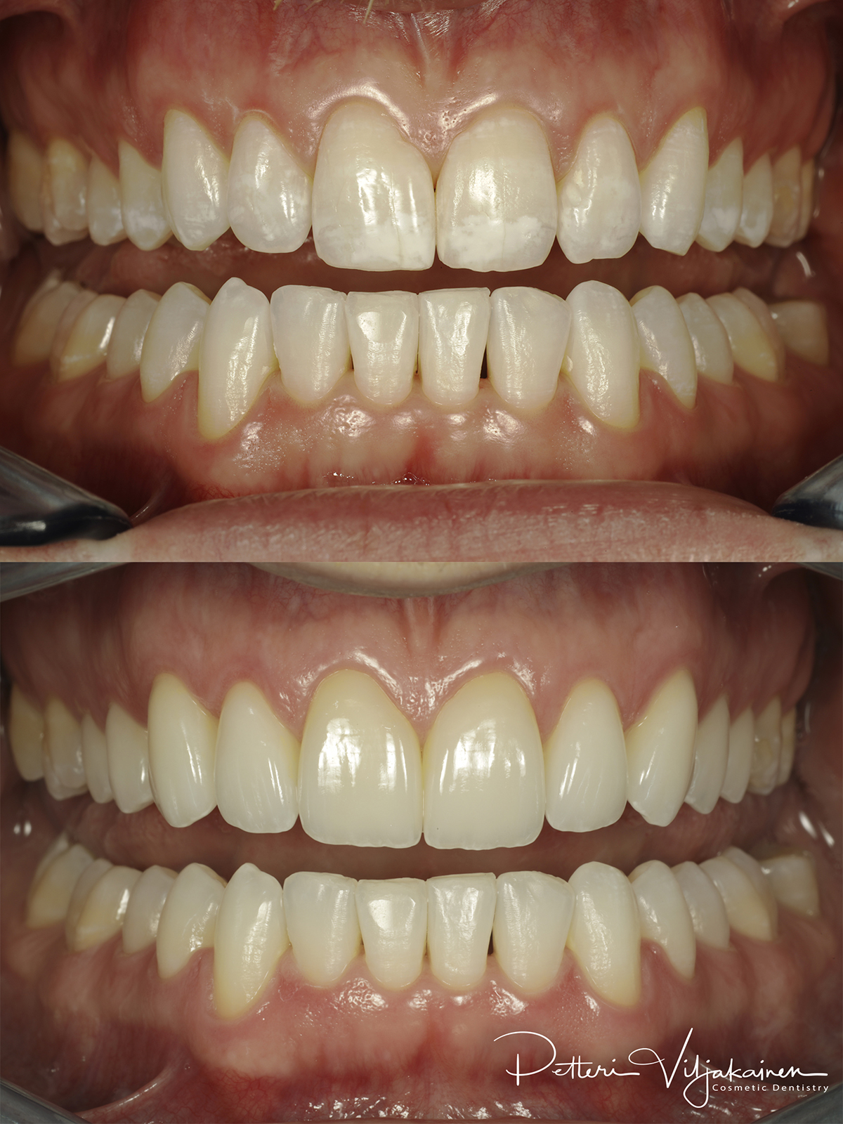 Esteettinen hammashoito Helsinki hampaat ennen