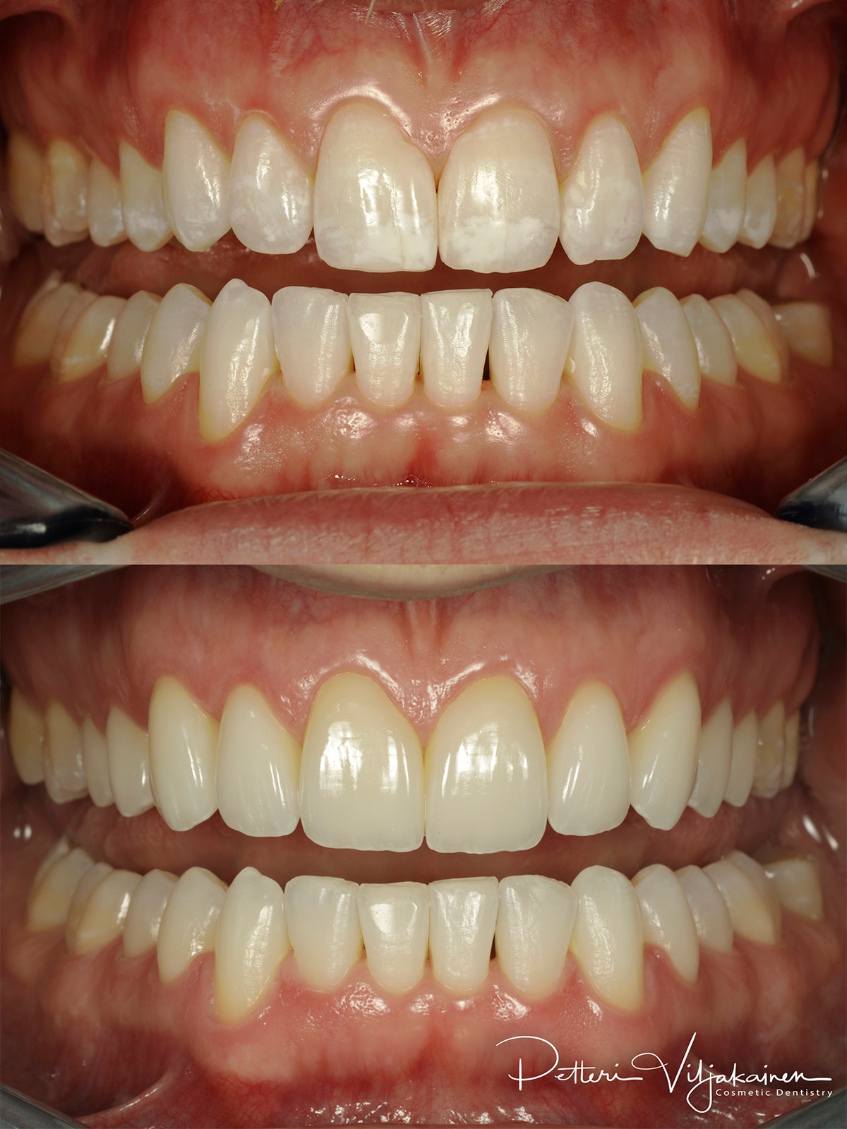 Esteettinen hammashoito Helsinki hampaat ennen
