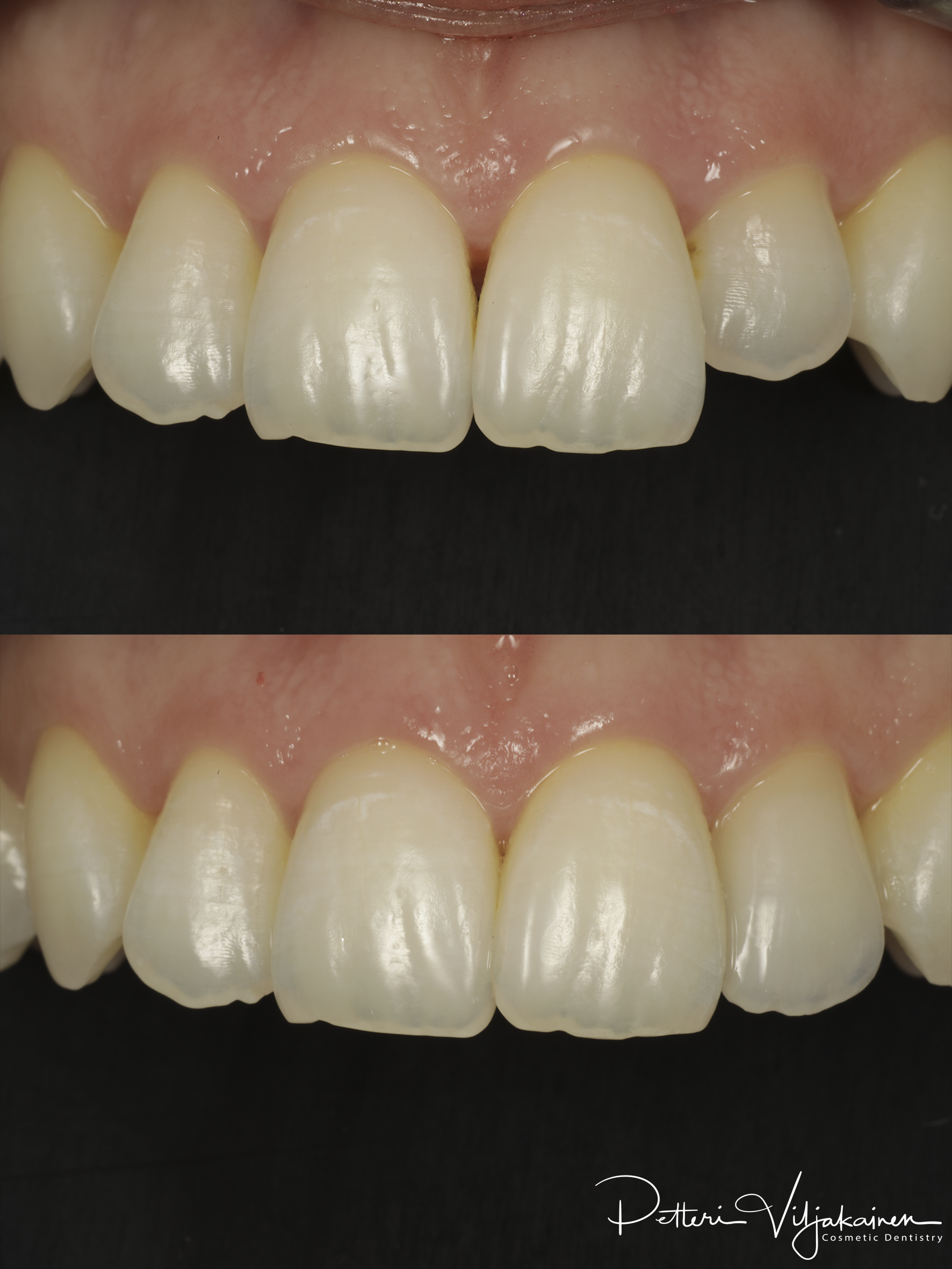 Esteettinen hammashoito Helsinki hampaat ennen