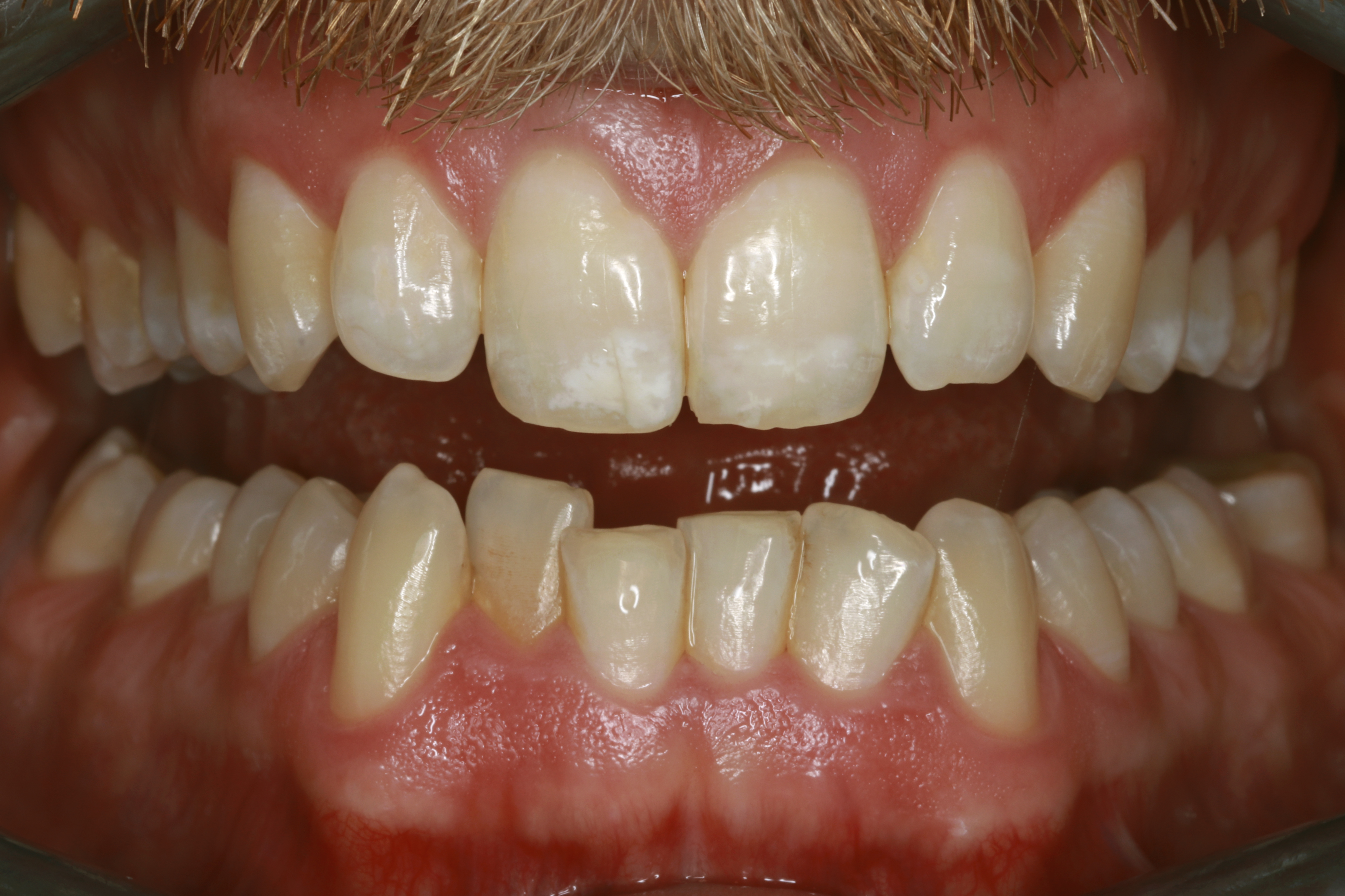 Esteettinen hammashoito Helsinki hampaat ennen