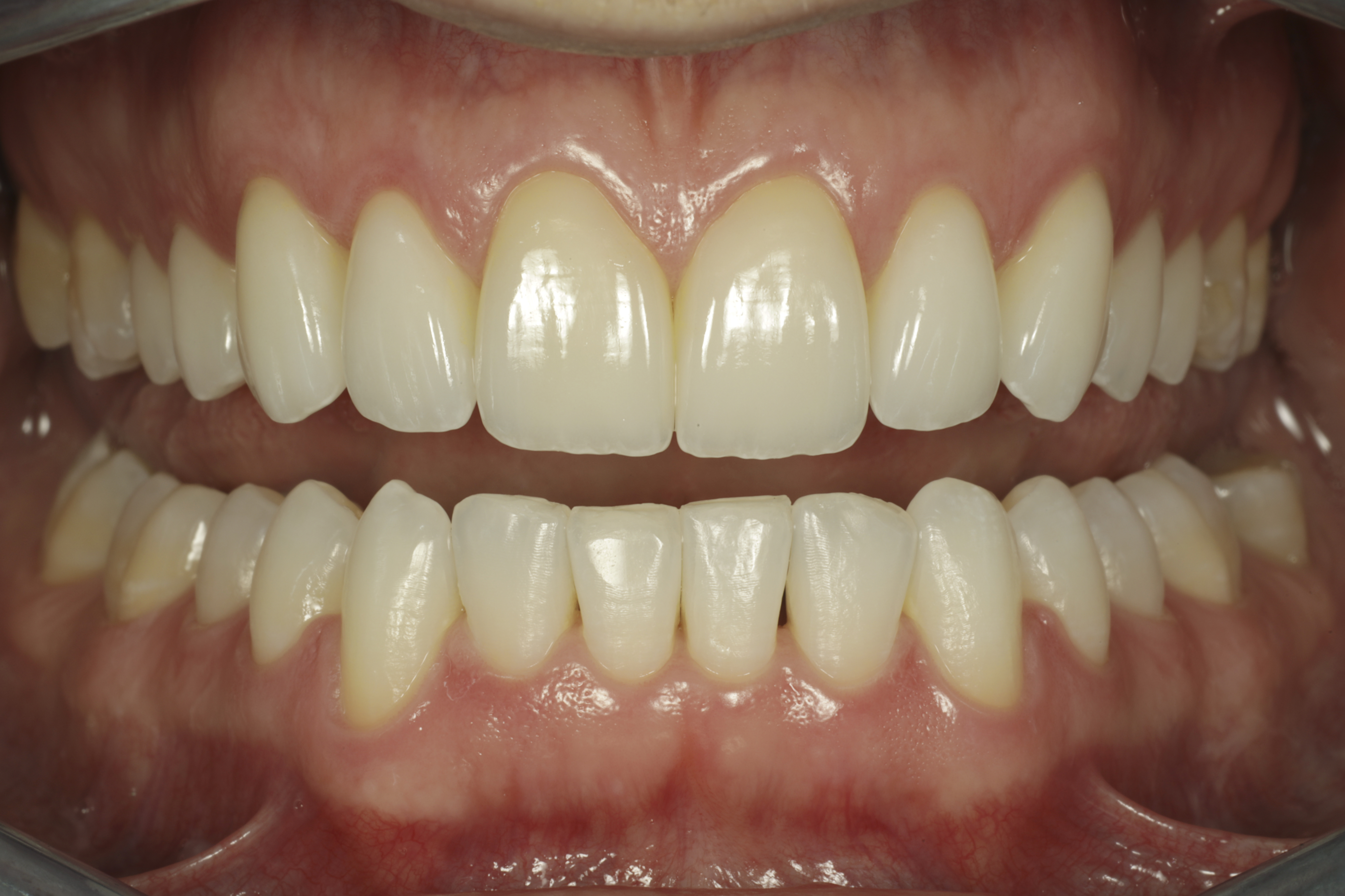 Esteettinen hammashoito Helsinki hampaat ennen