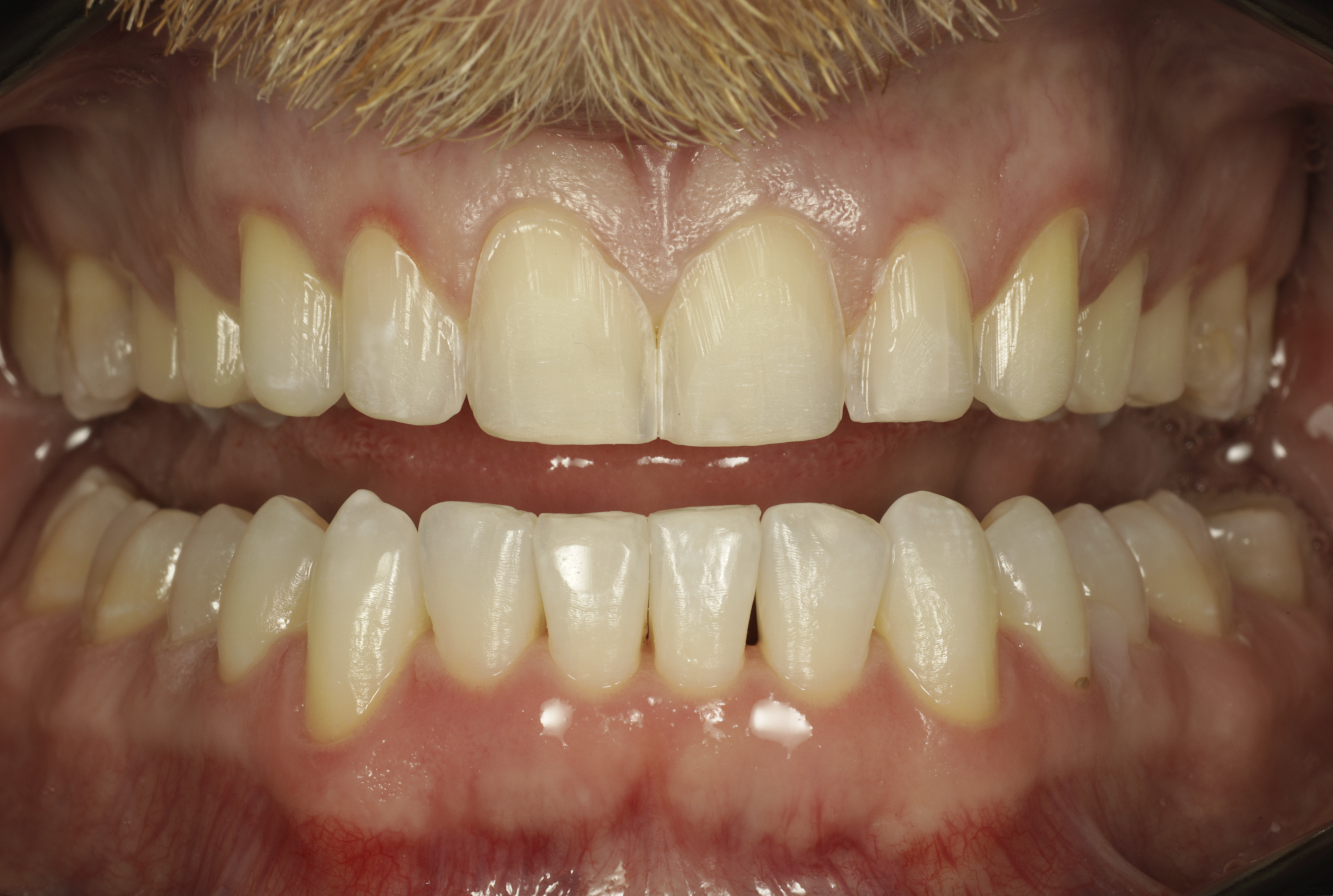 Esteettinen hammashoito Helsinki hampaat ennen