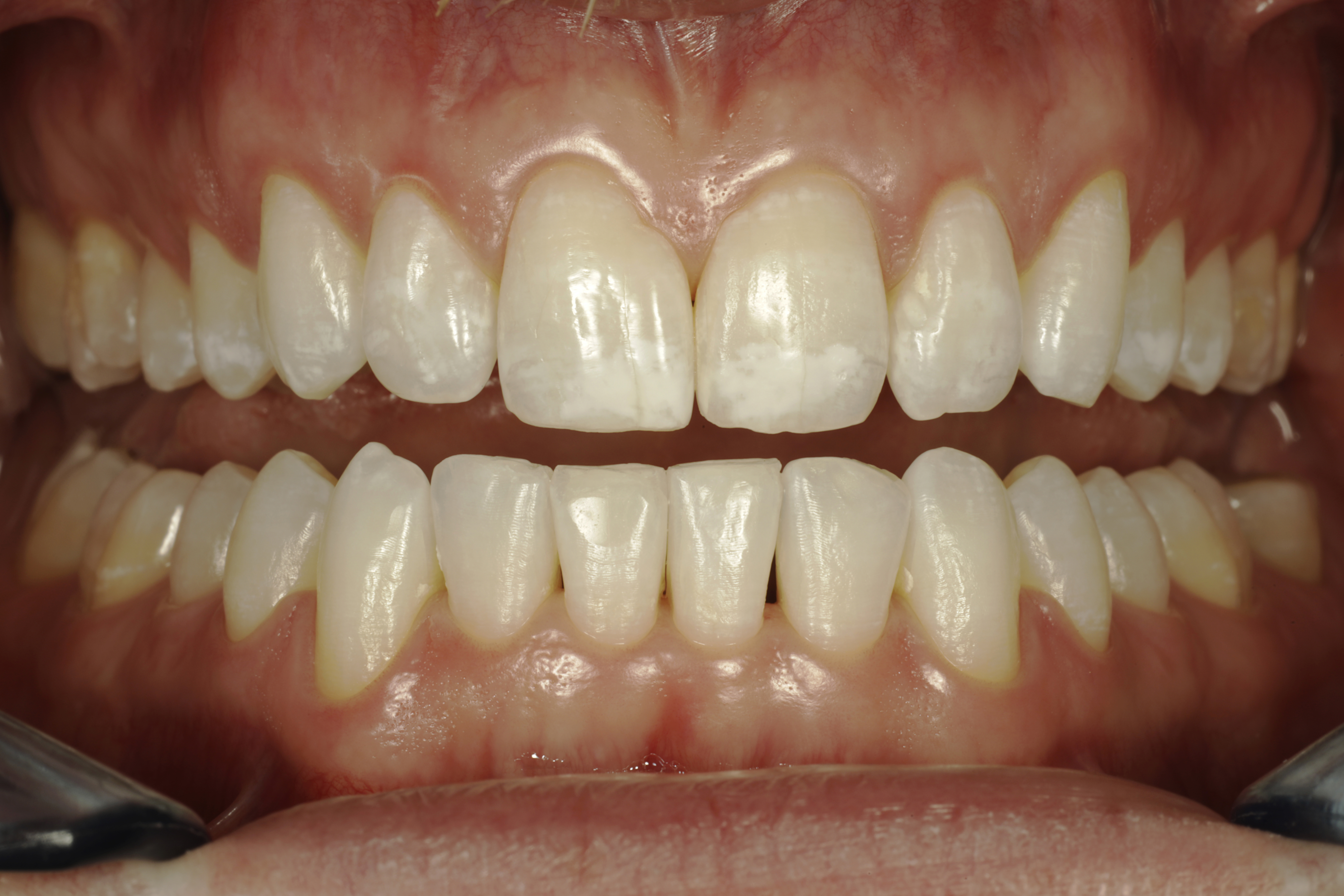 Esteettinen hammashoito Helsinki hampaat ennen