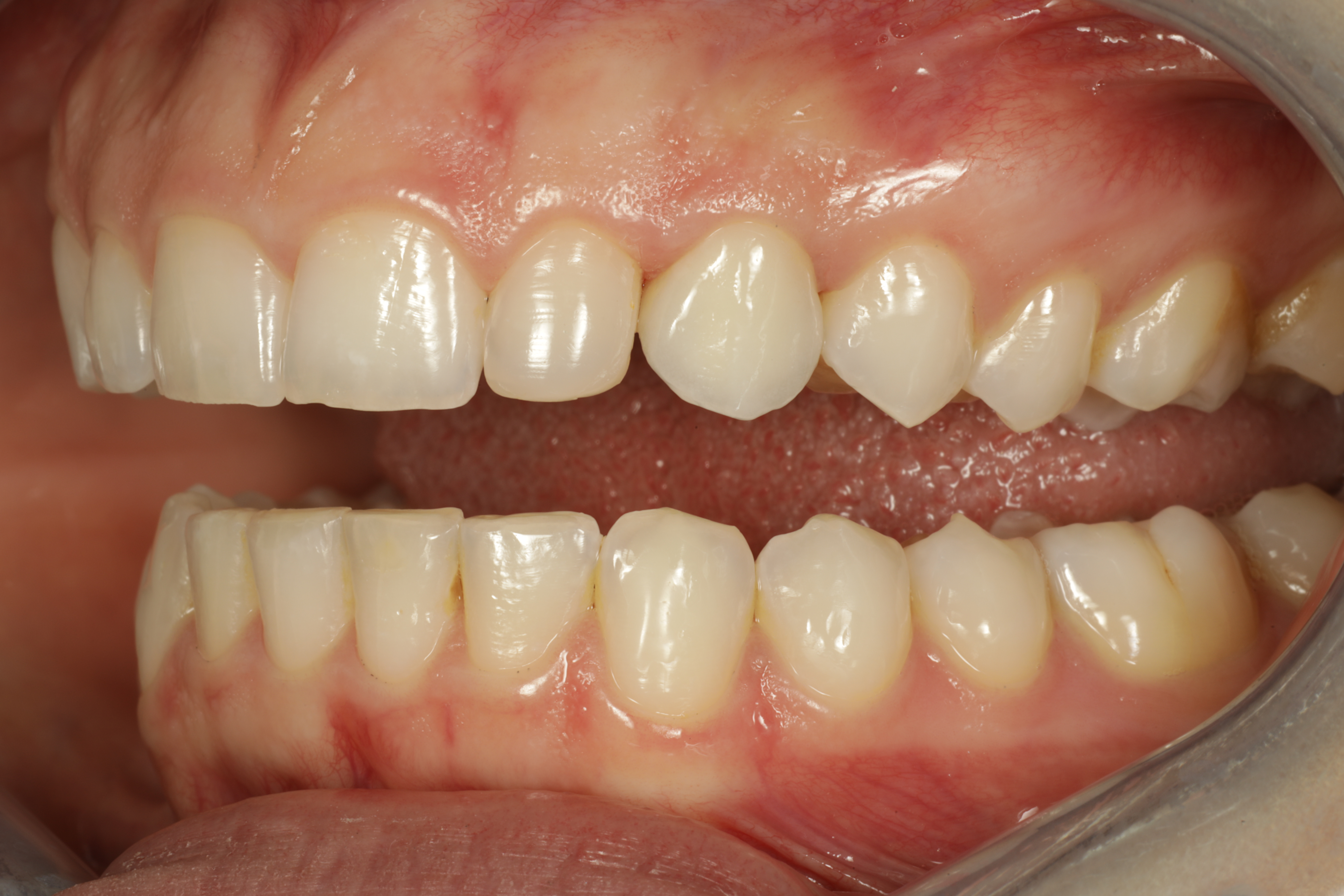 Esteettinen hammashoito Helsinki hampaat ennen