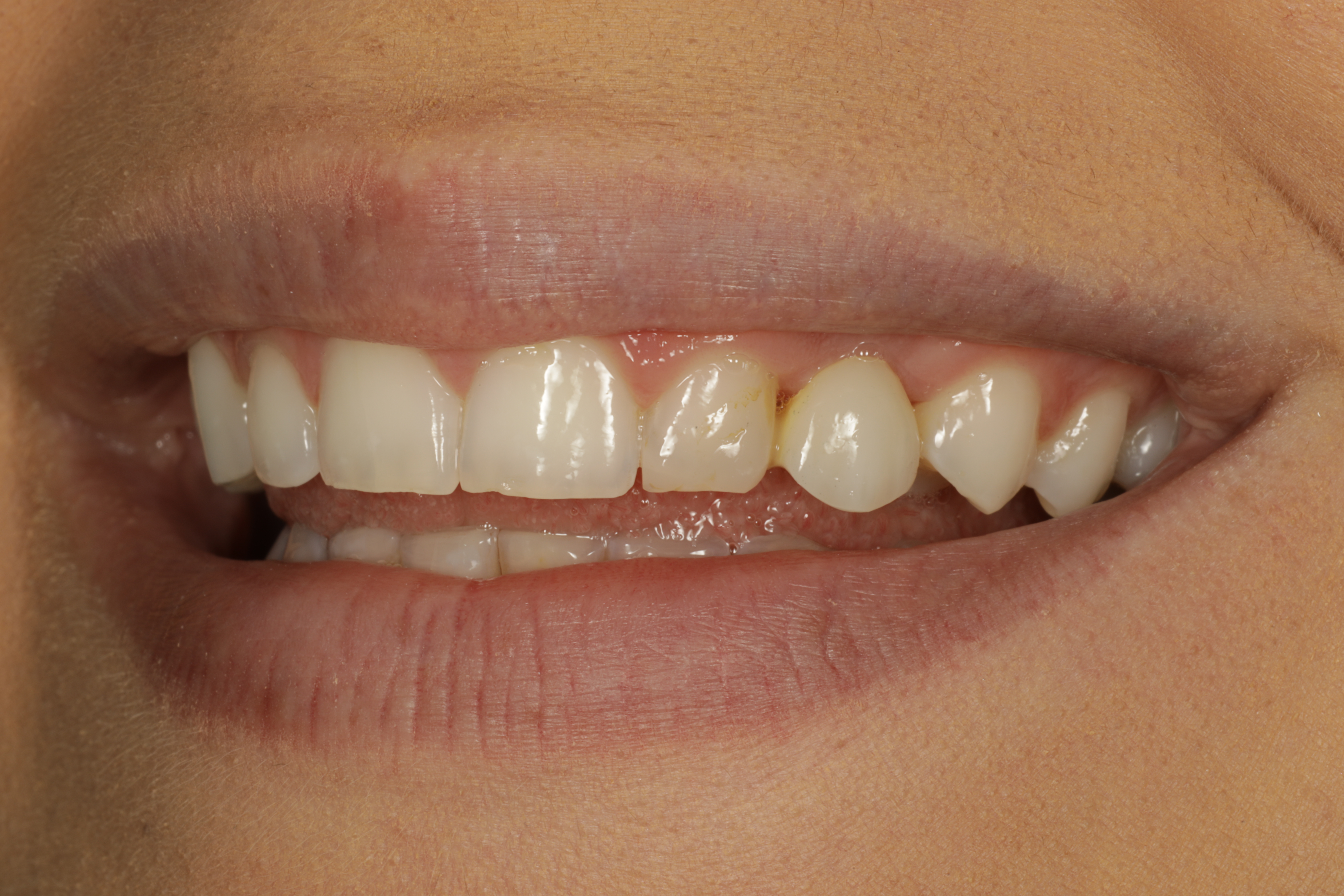 Esteettinen hammashoito Helsinki hampaat ennen