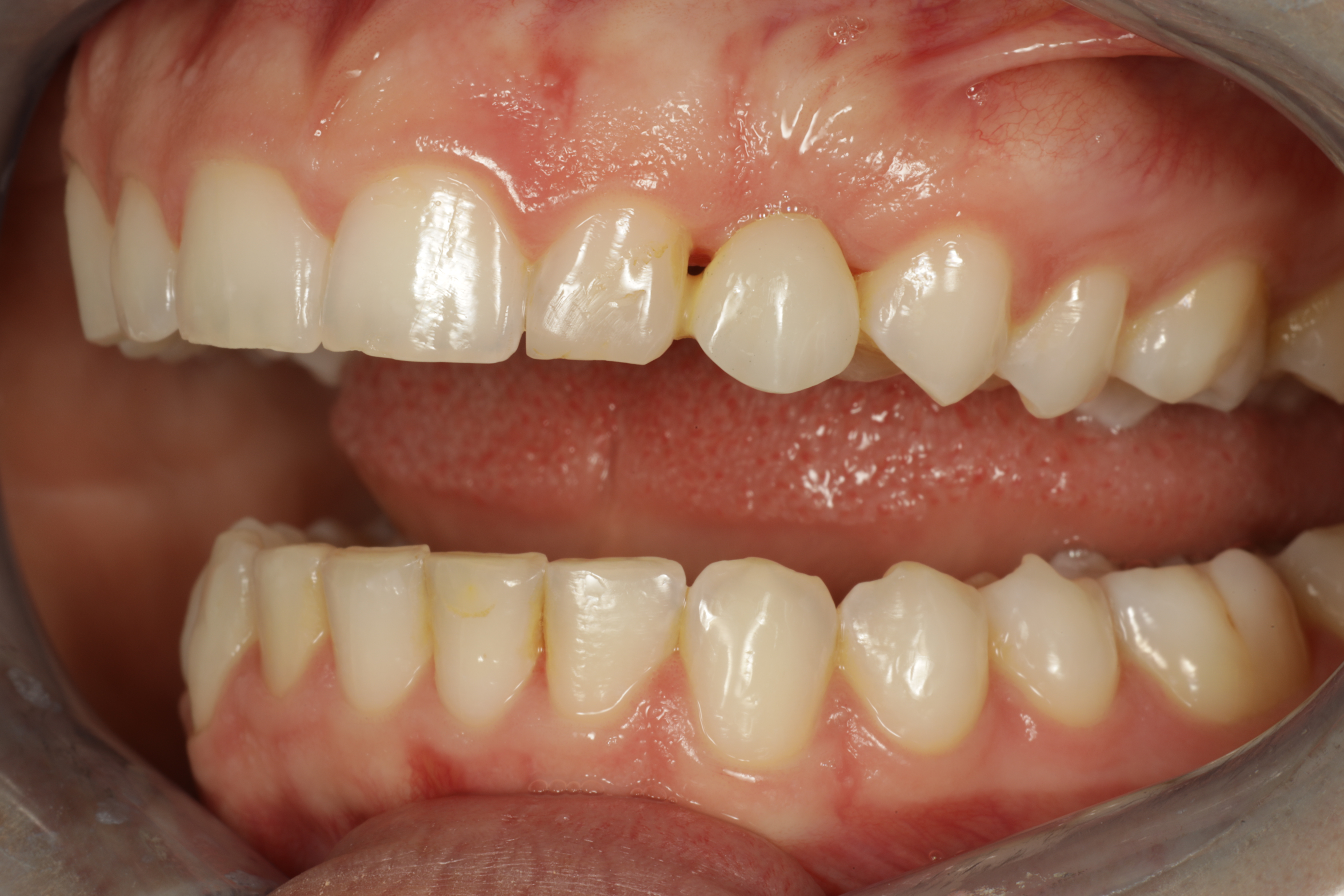 Esteettinen hammashoito Helsinki hampaat ennen