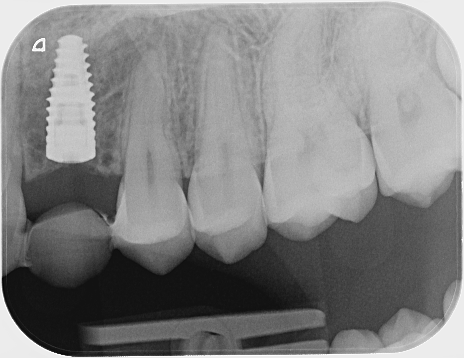 Esteettinen hammashoito Helsinki hampaat ennen