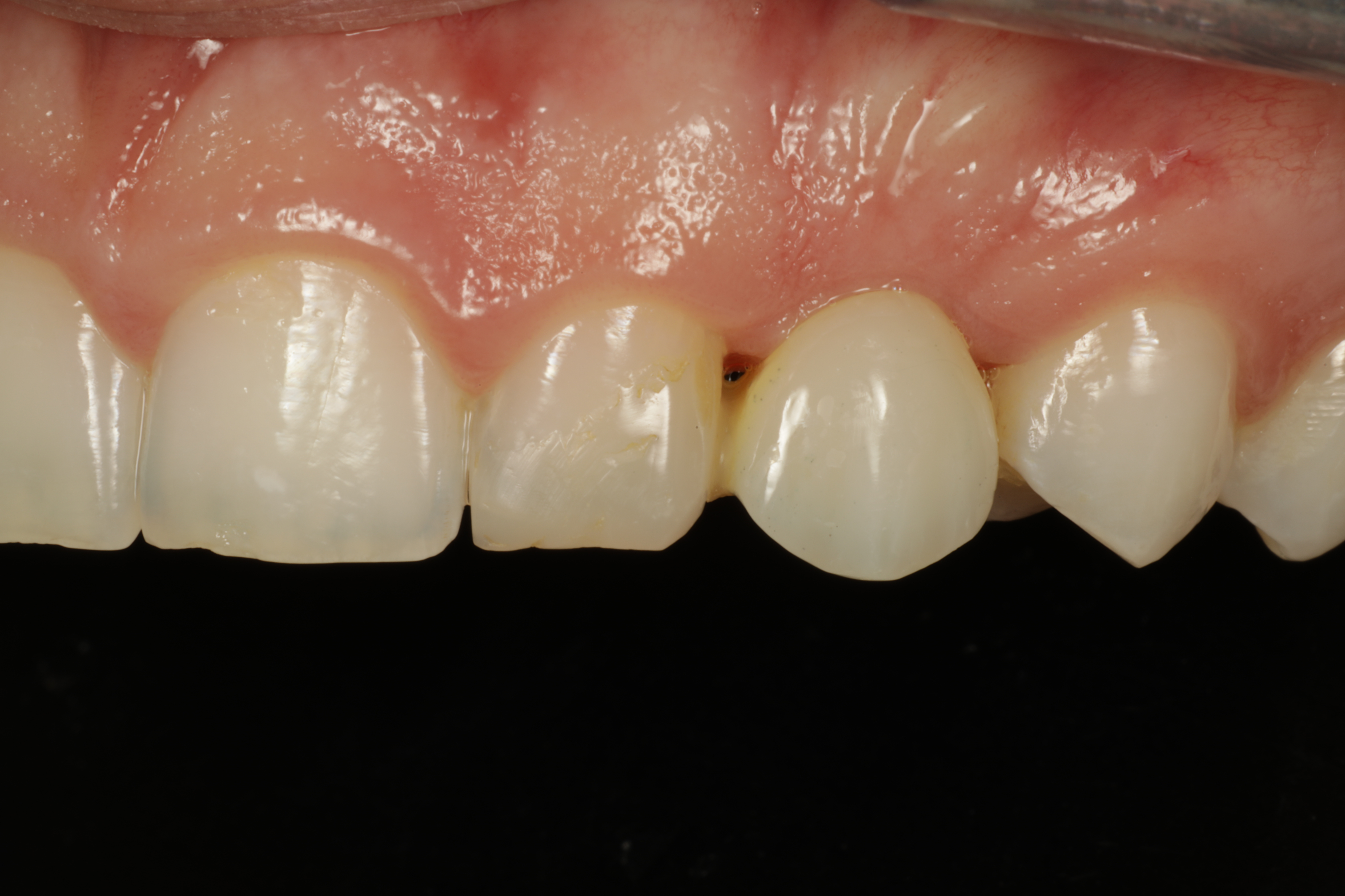 Esteettinen hammashoito Helsinki hampaat ennen