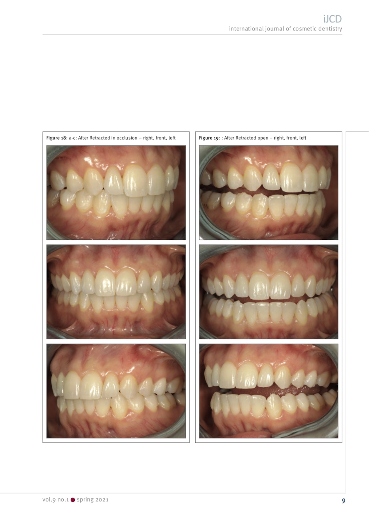 Esteettinen hammashoito Helsinki hampaat jälkeen