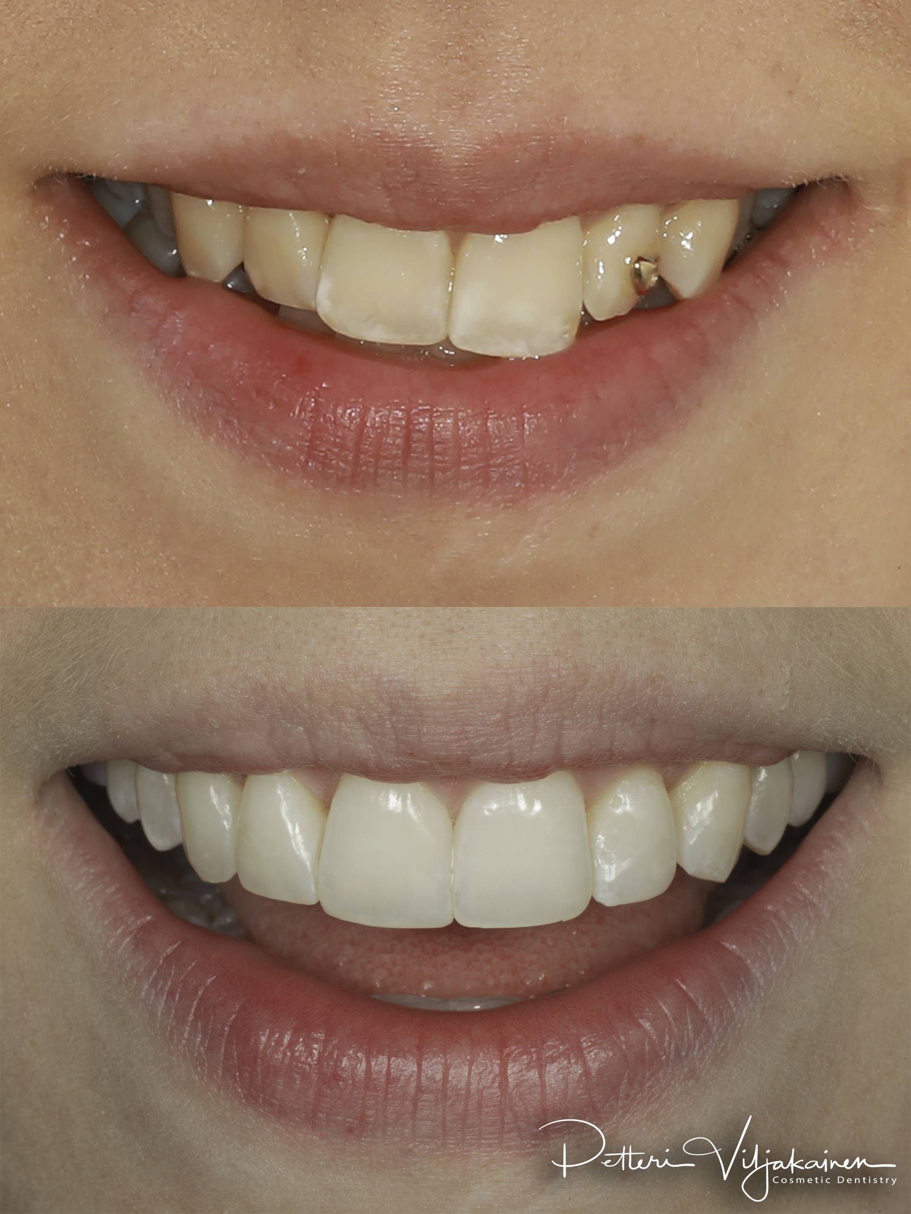 Oikomishoito ennen/jälkeen.