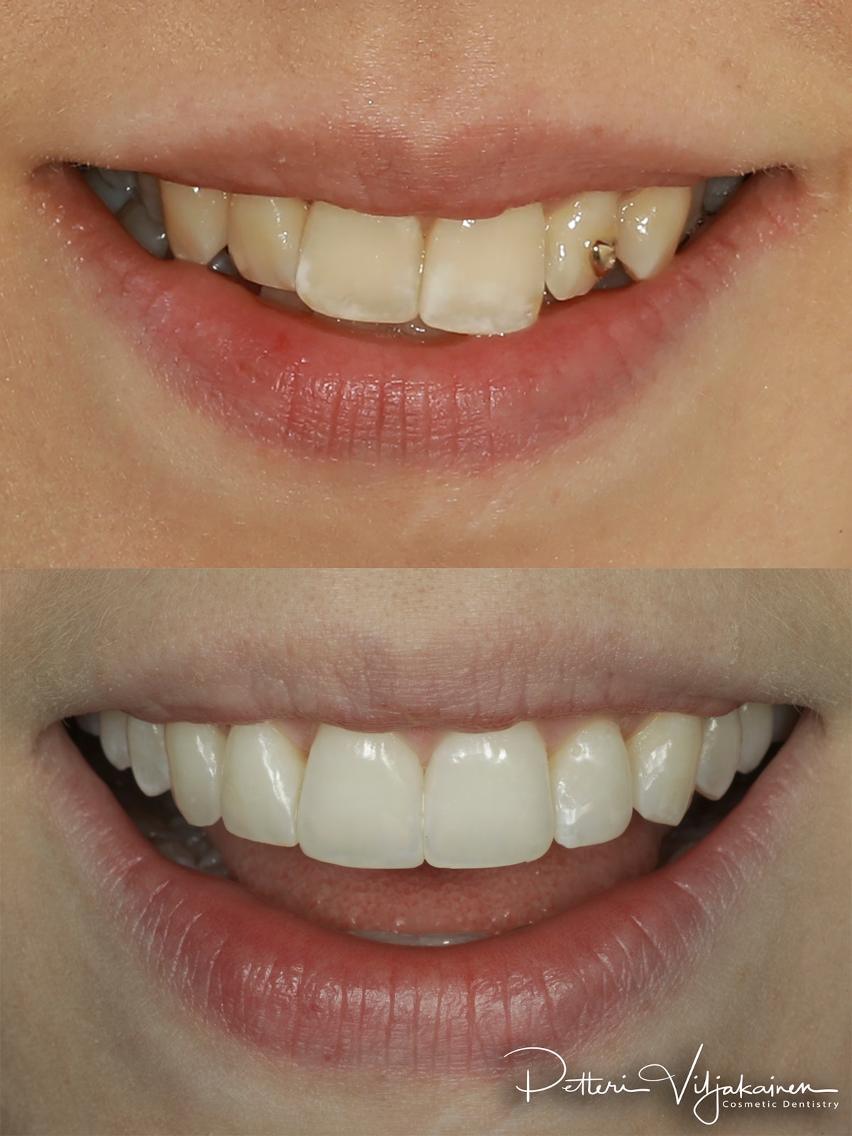 Oikomishoito ennen/jälkeen.