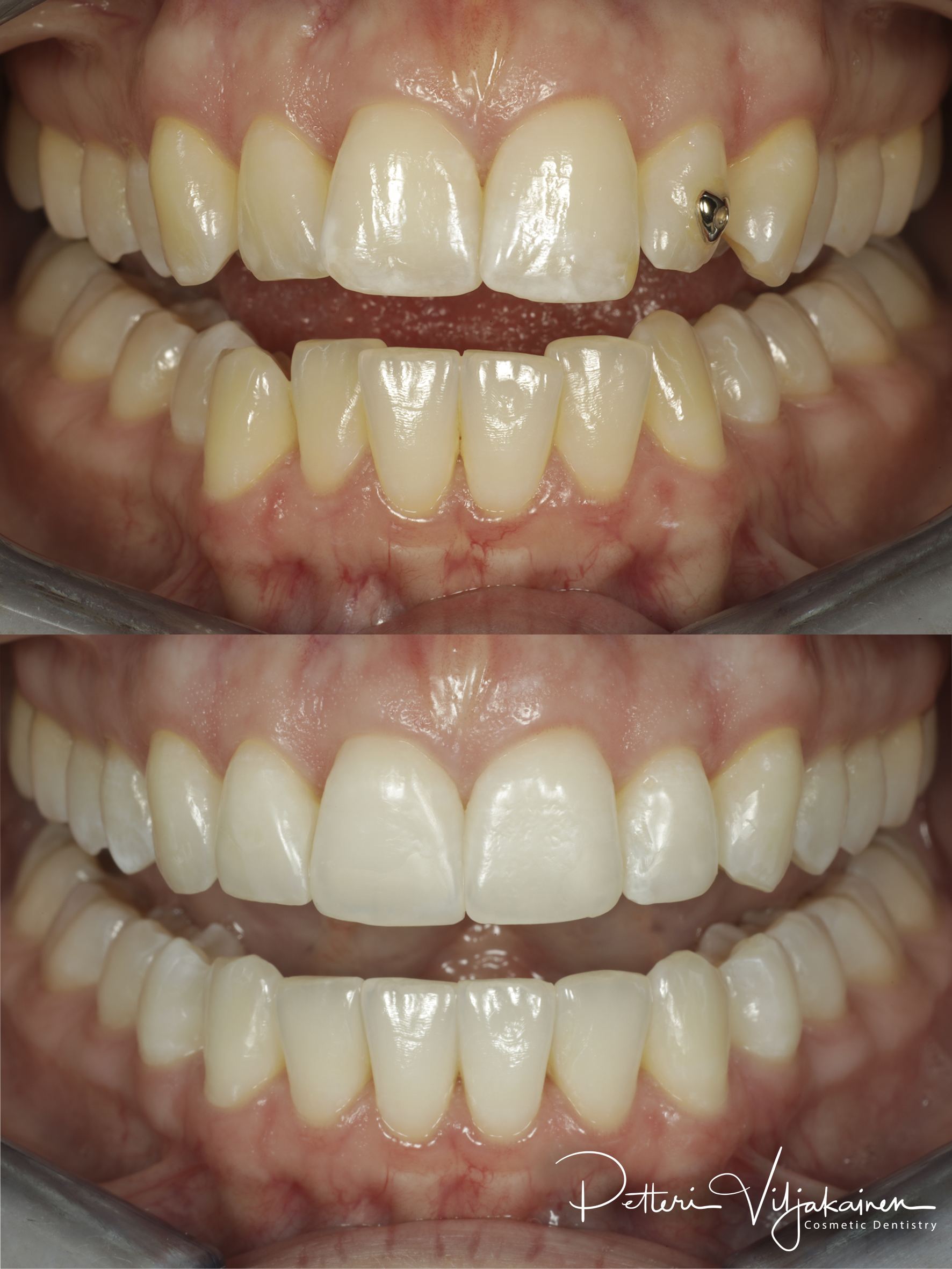 Oikomishoito ennen/jälkeen.