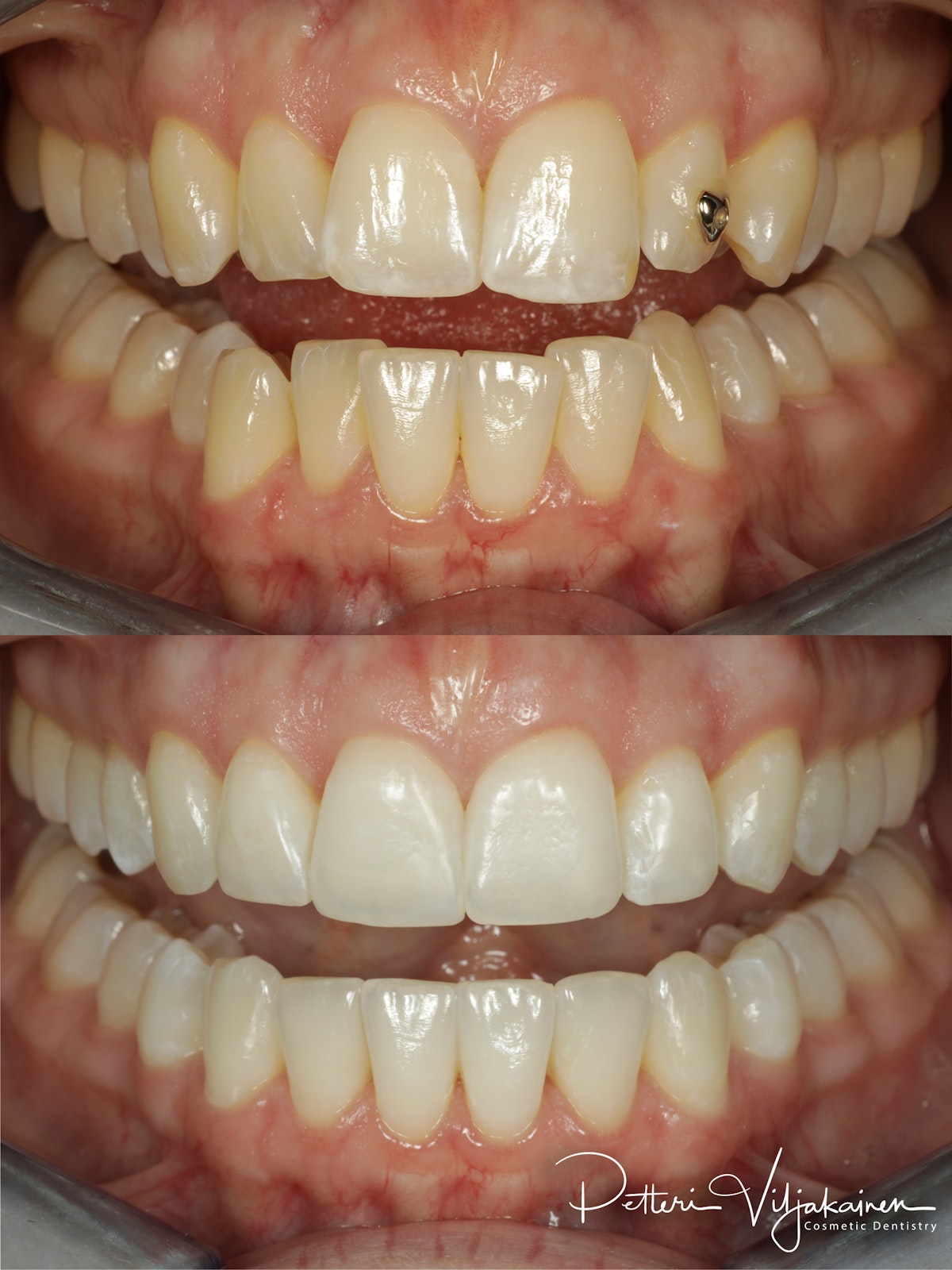 Oikomishoito ennen/jälkeen.