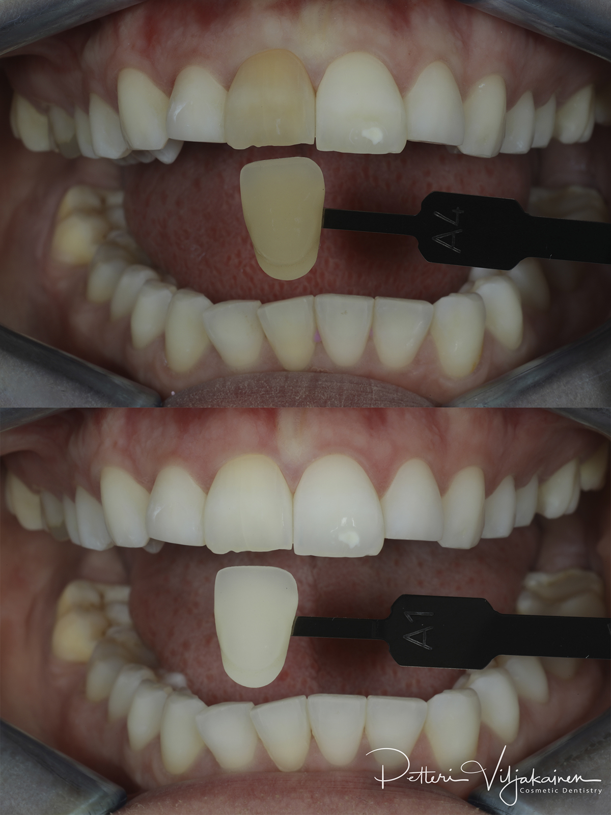 Hampaiden valkaisu, endovalkaisu, juurihoidetun hampaan sisäinen valkaisu.
