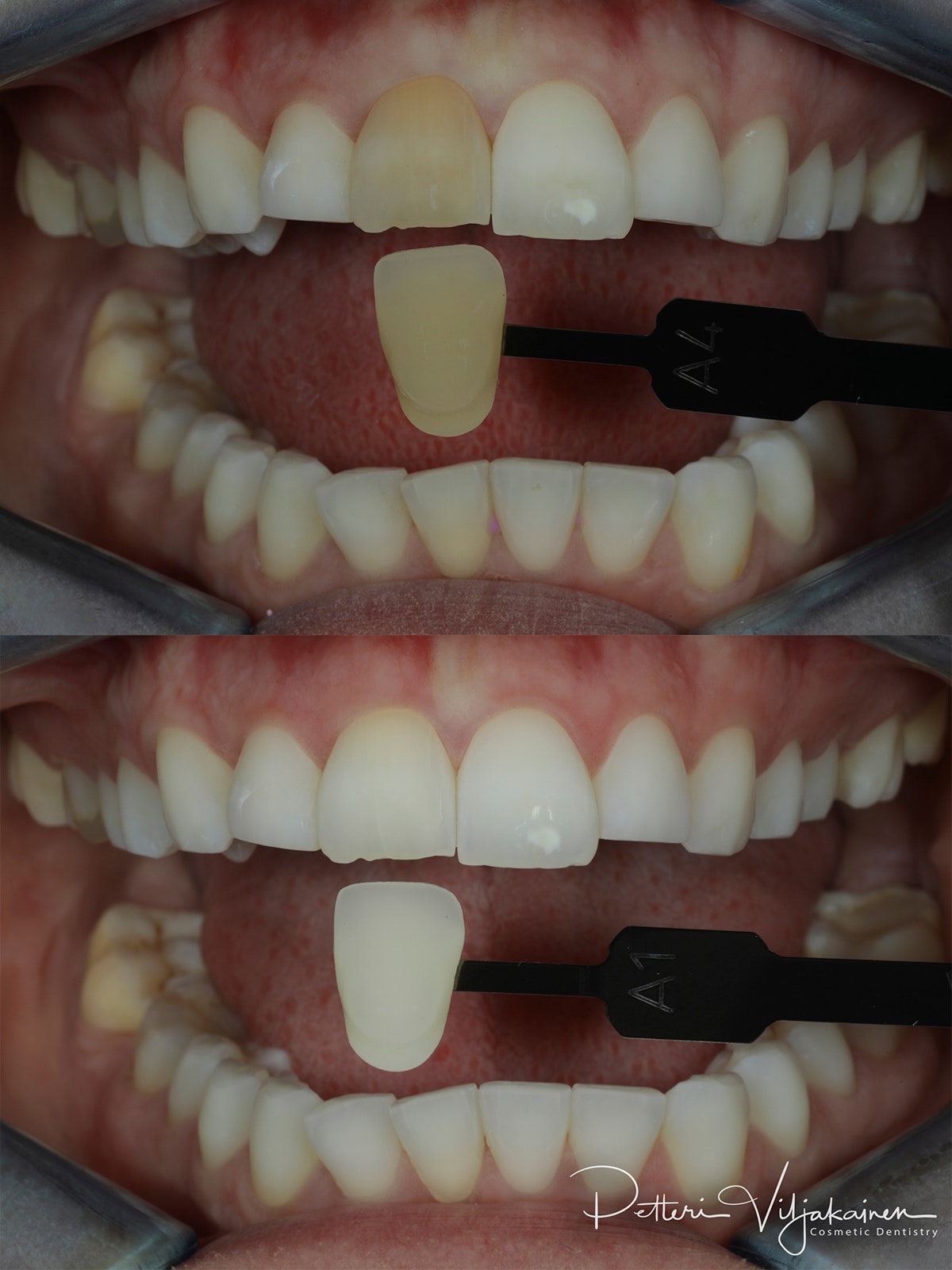Hampaiden valkaisu, endovalkaisu, juurihoidetun hampaan sisäinen valkaisu.