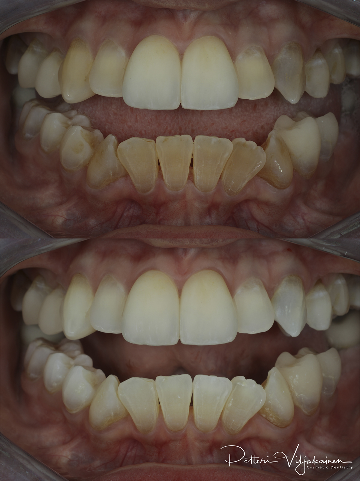 Esteettinen hammashoito Helsinki hampaat ennen