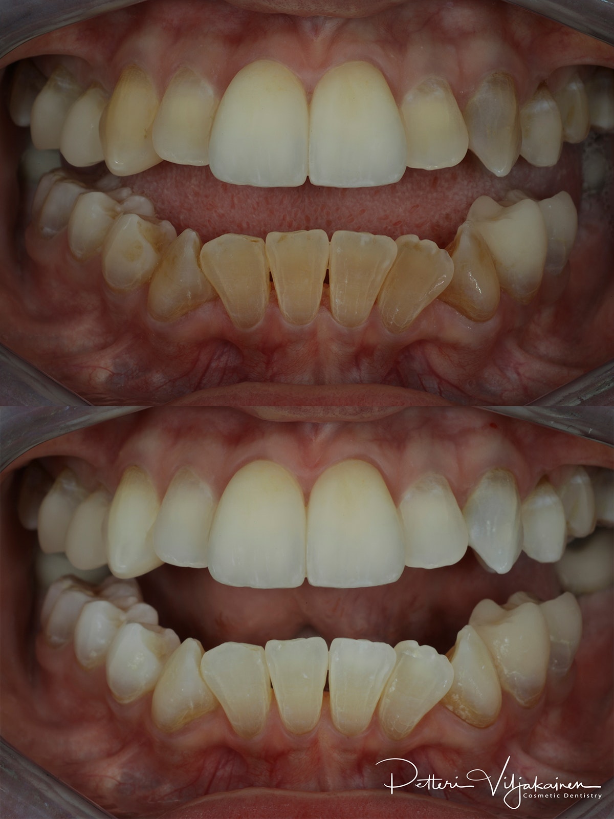 Esteettinen hammashoito Helsinki hampaat ennen
