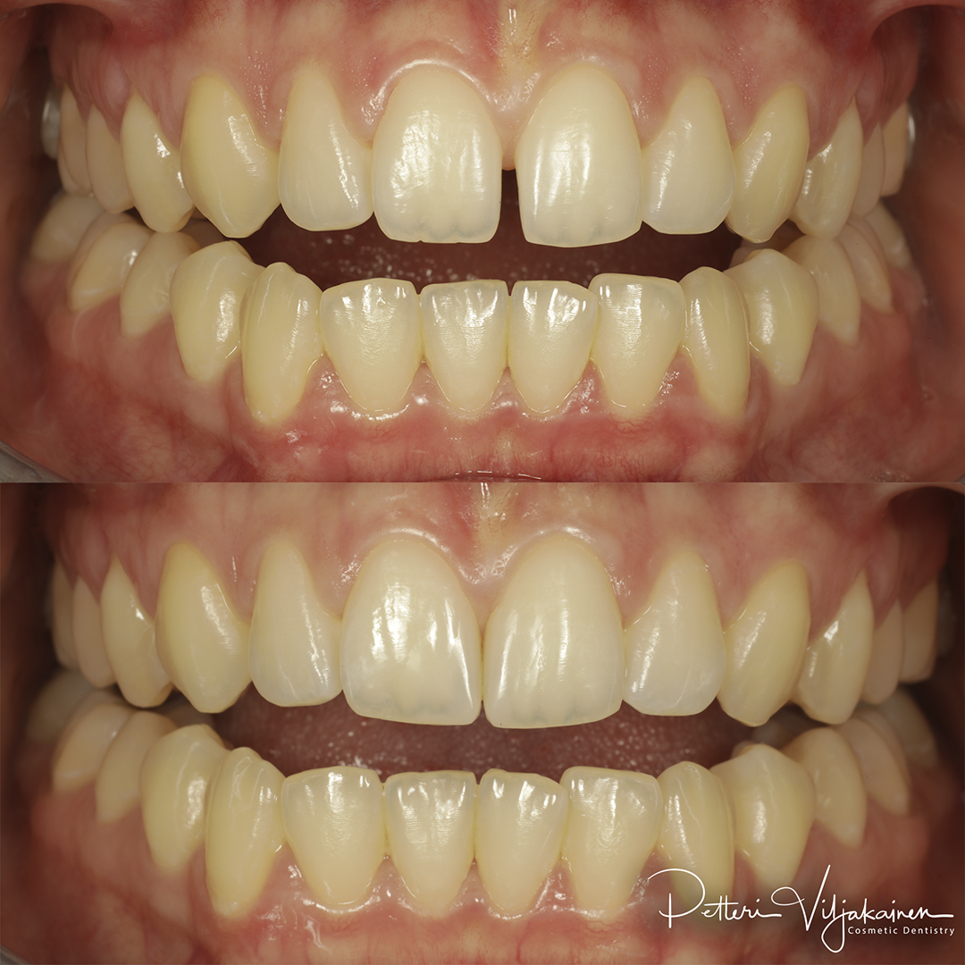 Esteettinen hammashoito Helsinki hampaat ennen