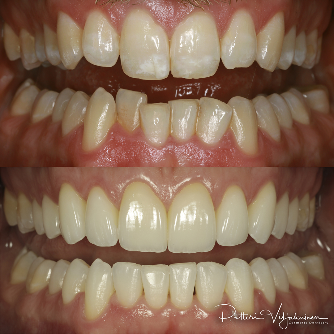 Esteettinen hammashoito Helsinki hampaat ennen