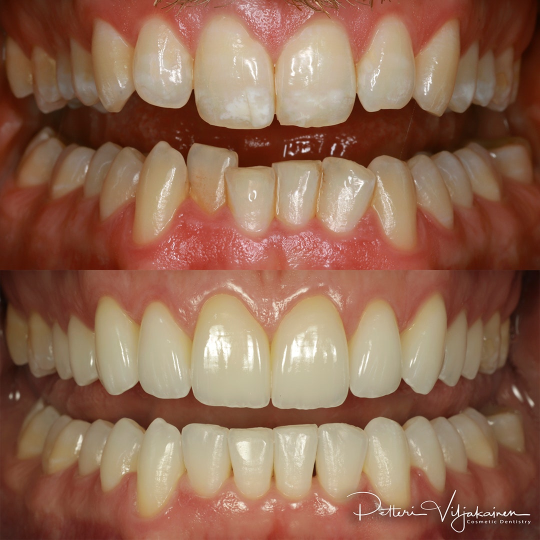 Esteettinen hammashoito Helsinki hampaat ennen