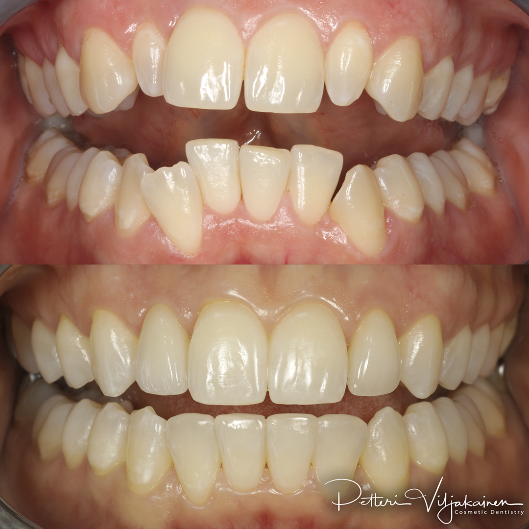 Esteettinen hammashoito Helsinki hampaat ennen