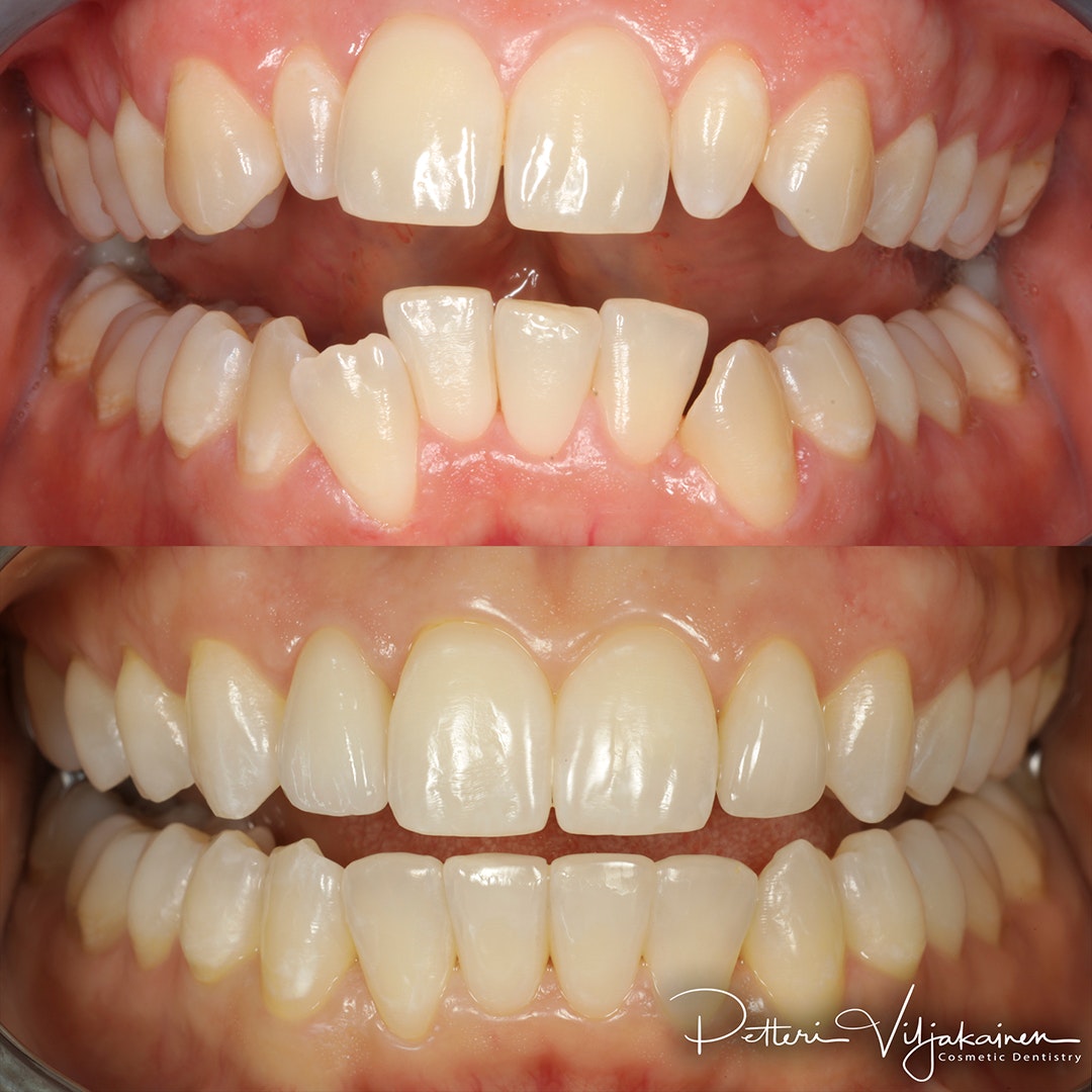 Esteettinen hammashoito Helsinki hampaat ennen