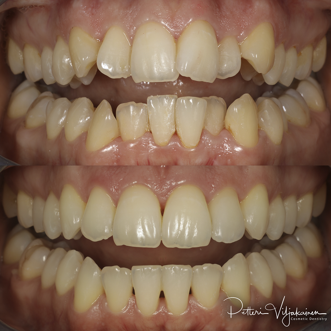Esteettinen hammashoito Helsinki hampaat ennen
