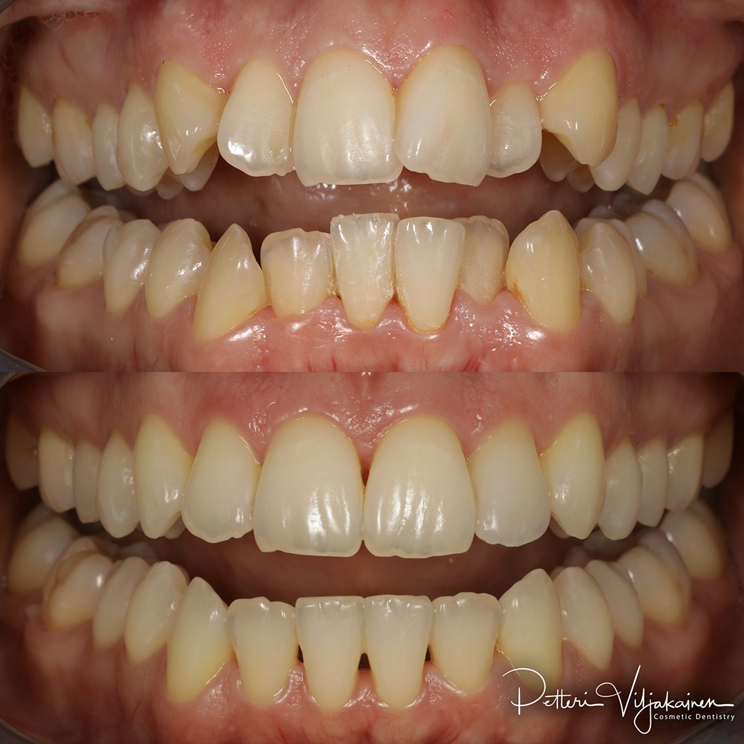 Esteettinen hammashoito Helsinki hampaat ennen