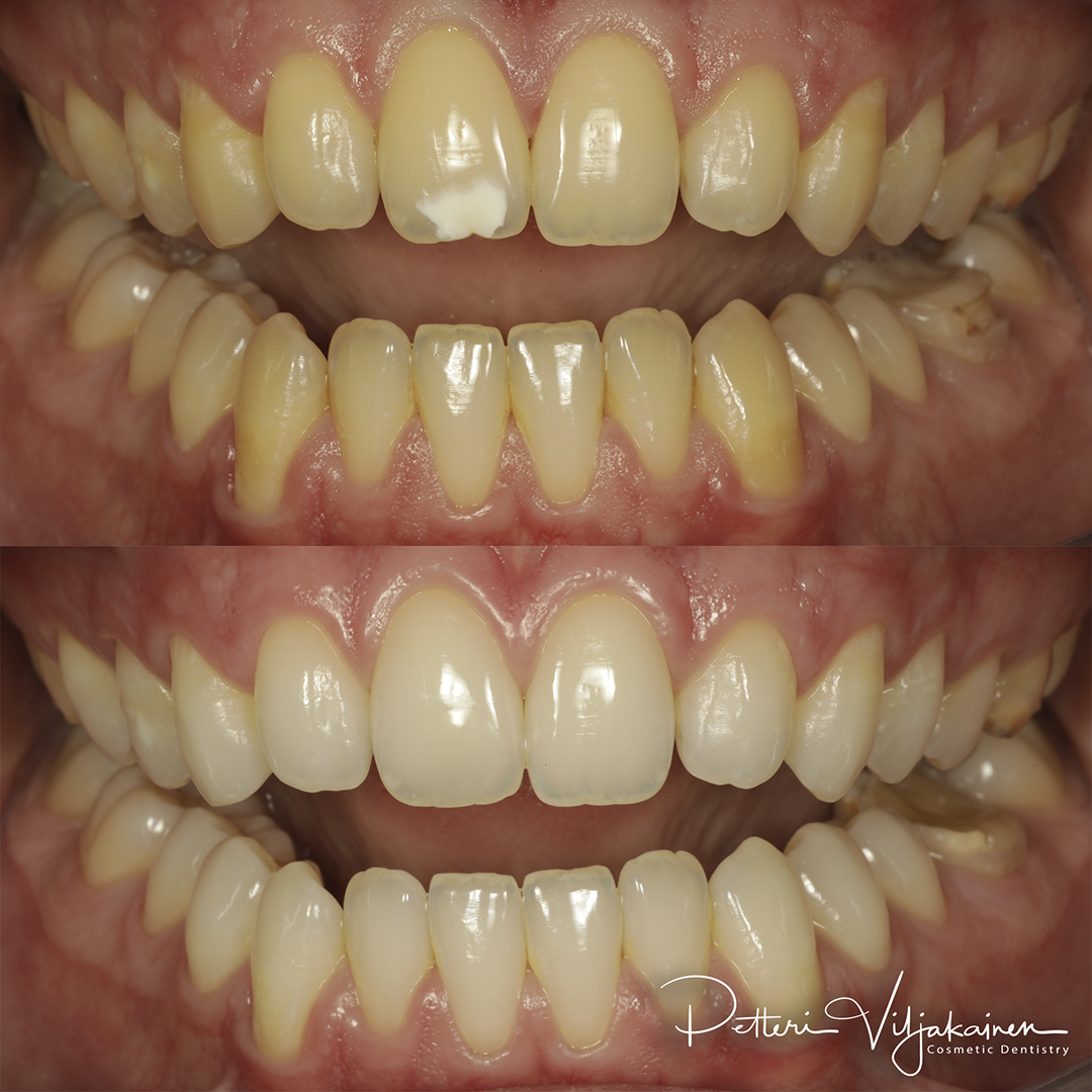 Esteettinen hammashoito Helsinki hampaat ennen