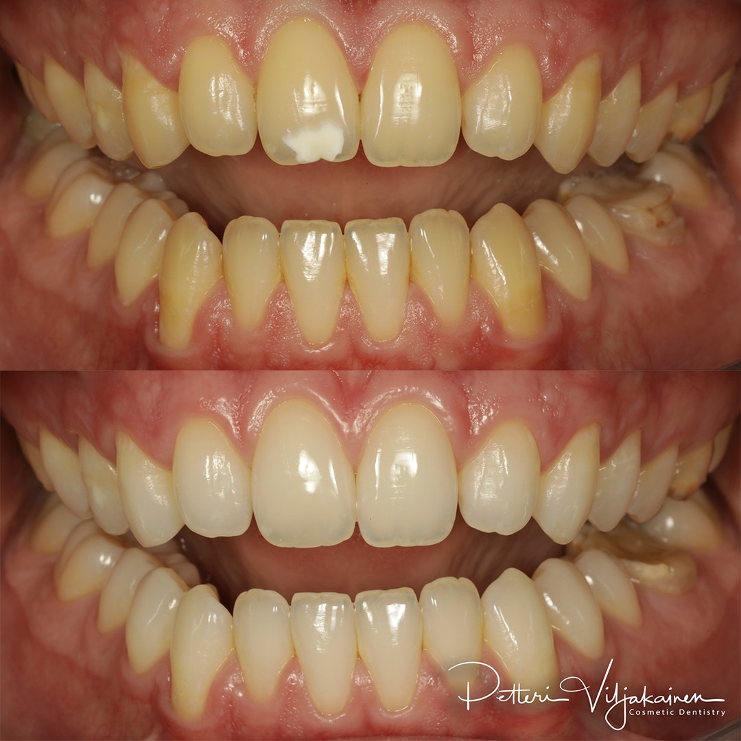 Esteettinen hammashoito Helsinki hampaat ennen