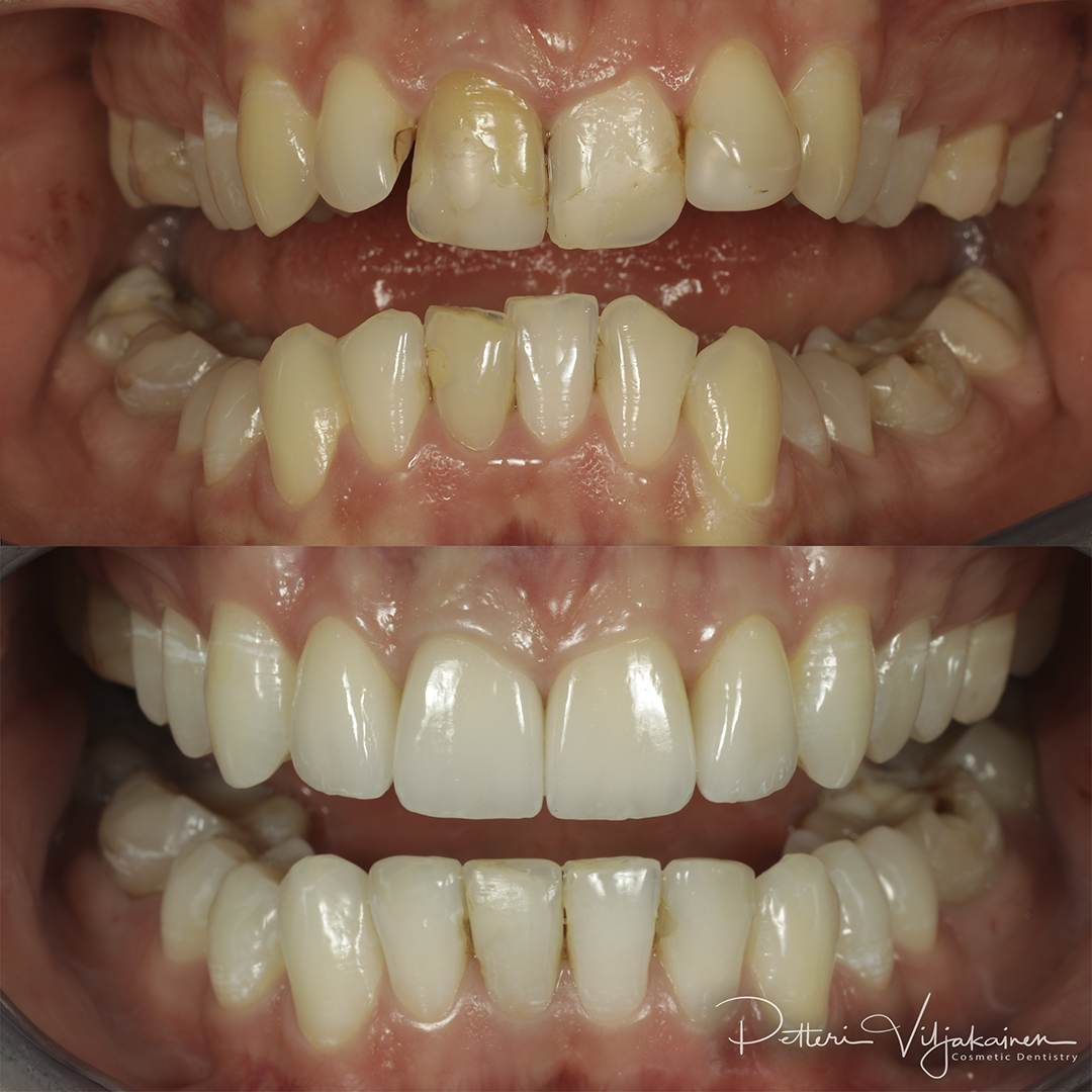 Esteettinen hammashoito Helsinki hampaat ennen