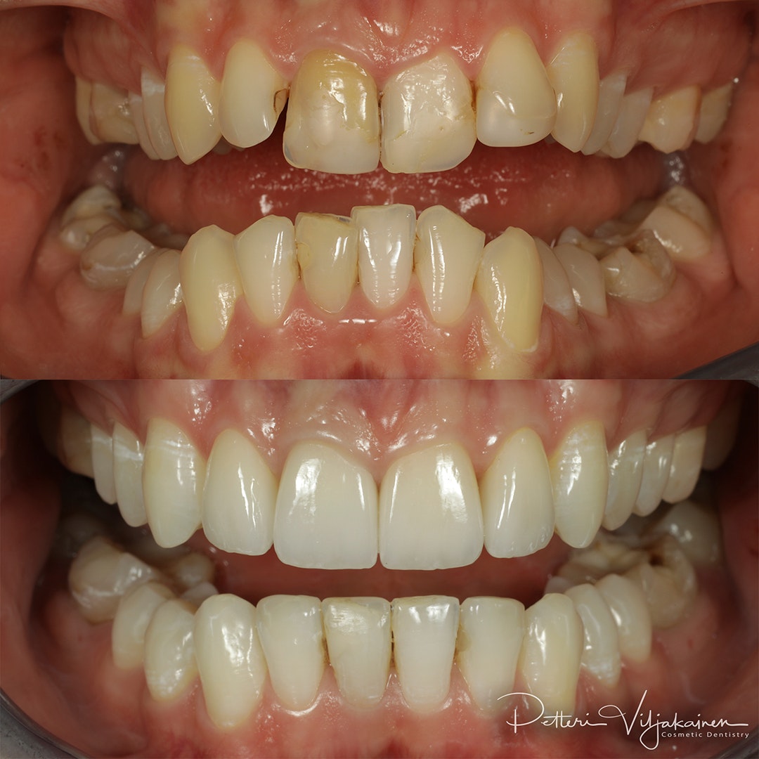 Esteettinen hammashoito Helsinki hampaat ennen
