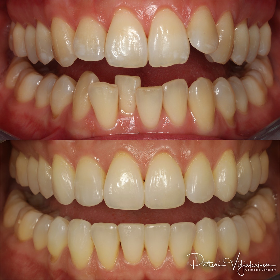 Esteettinen hammashoito Helsinki hampaat ennen