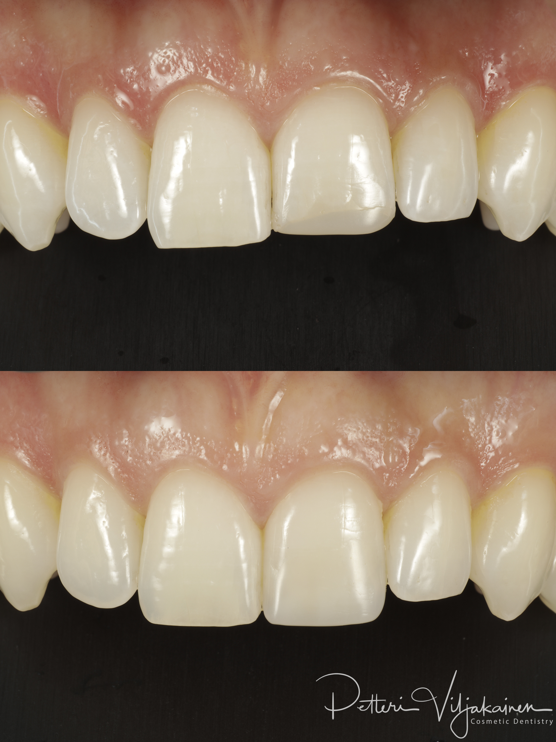 Esteettinen hammashoito Helsinki hampaat ennen