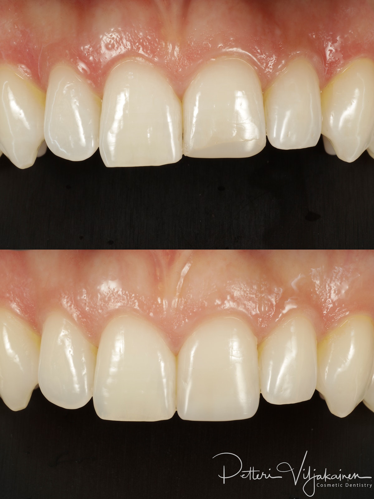 Esteettinen hammashoito Helsinki hampaat ennen