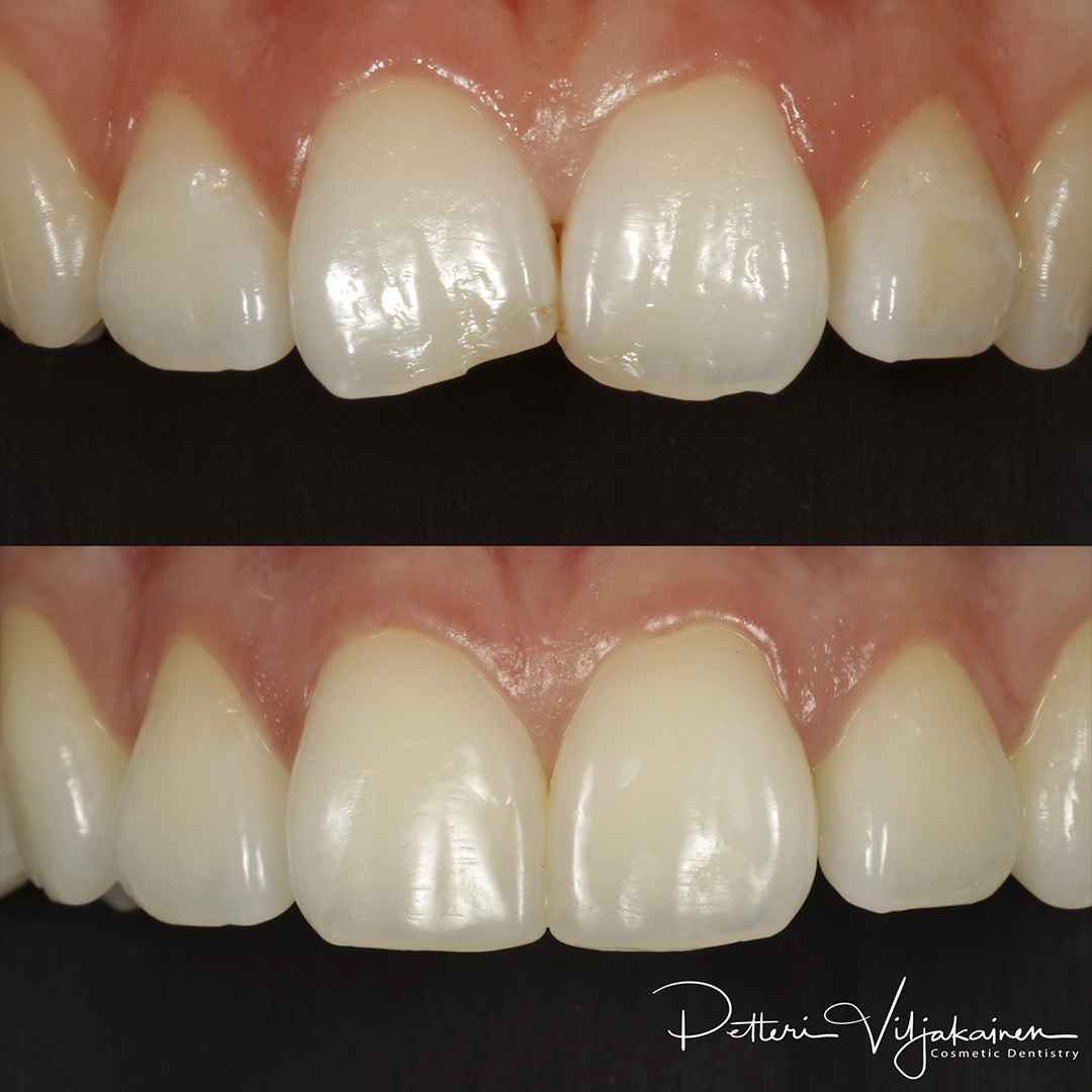 Esteettinen hammashoito Helsinki hampaat ennen