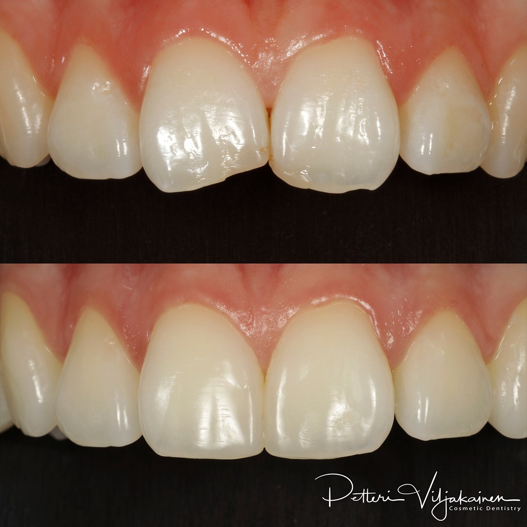Esteettinen hammashoito Helsinki hampaat ennen