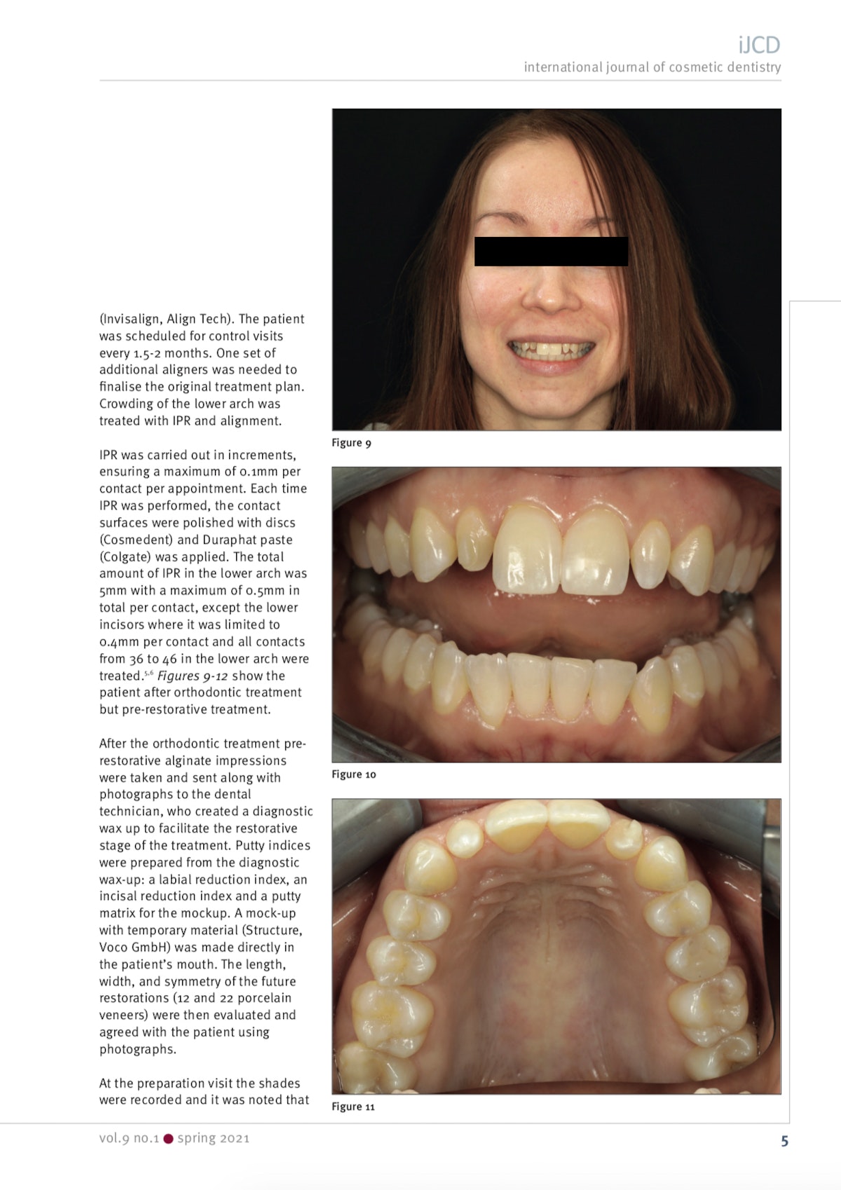 Esteettinen hammashoito Helsinki hampaat jälkeen