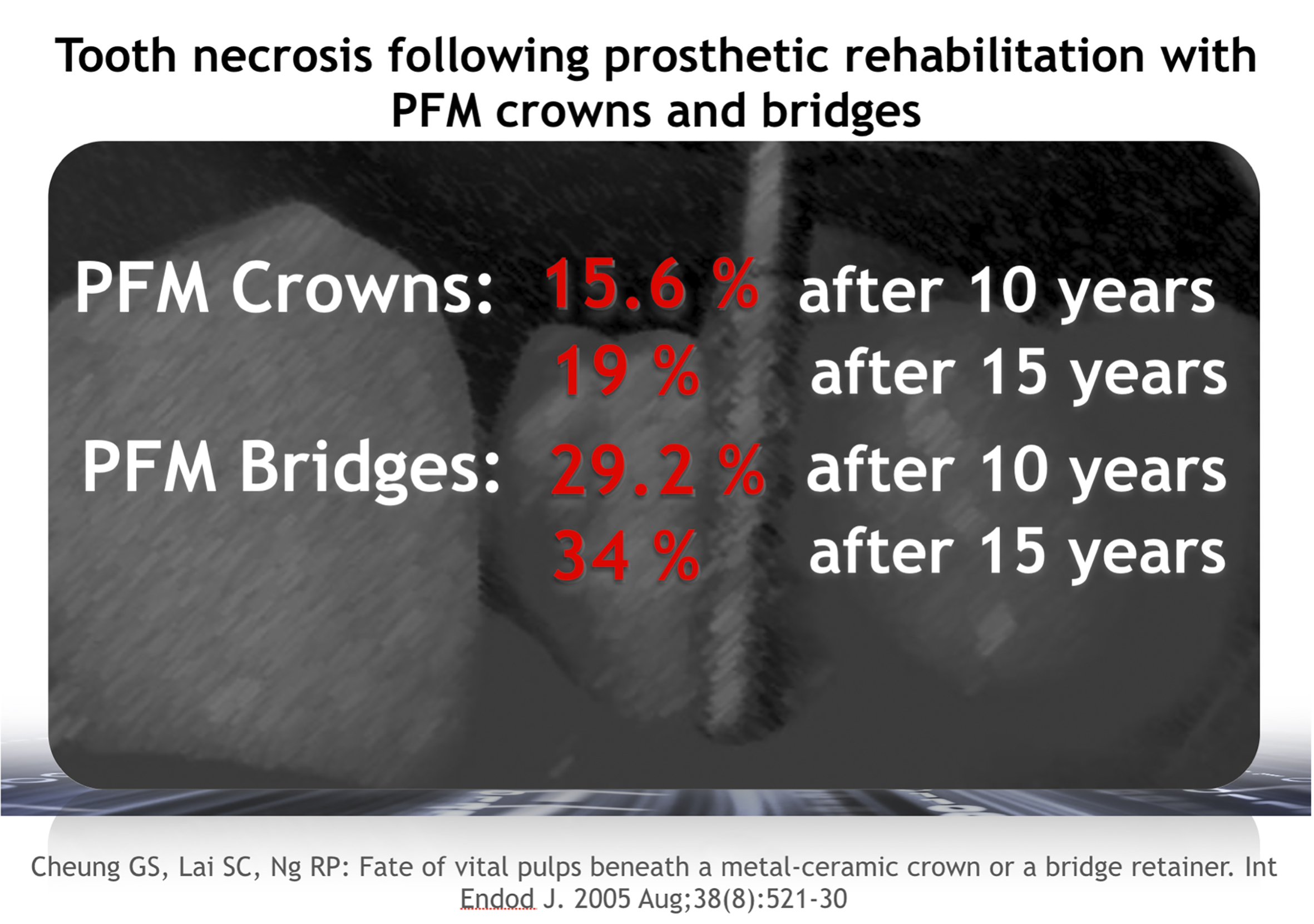 Invisalign oikomishoito ennen. Esteettiset kerrostusmuovit keskimmäisissä etuhampaissa.