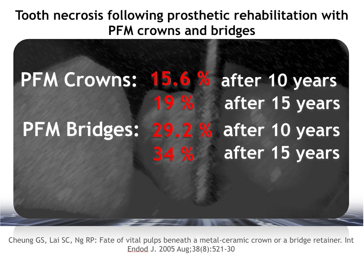 Invisalign oikomishoito ennen. Esteettiset kerrostusmuovit keskimmäisissä etuhampaissa.