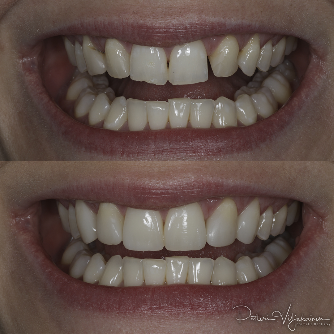 Invisalign oikomishoito. Tyytyväinen asiakas.